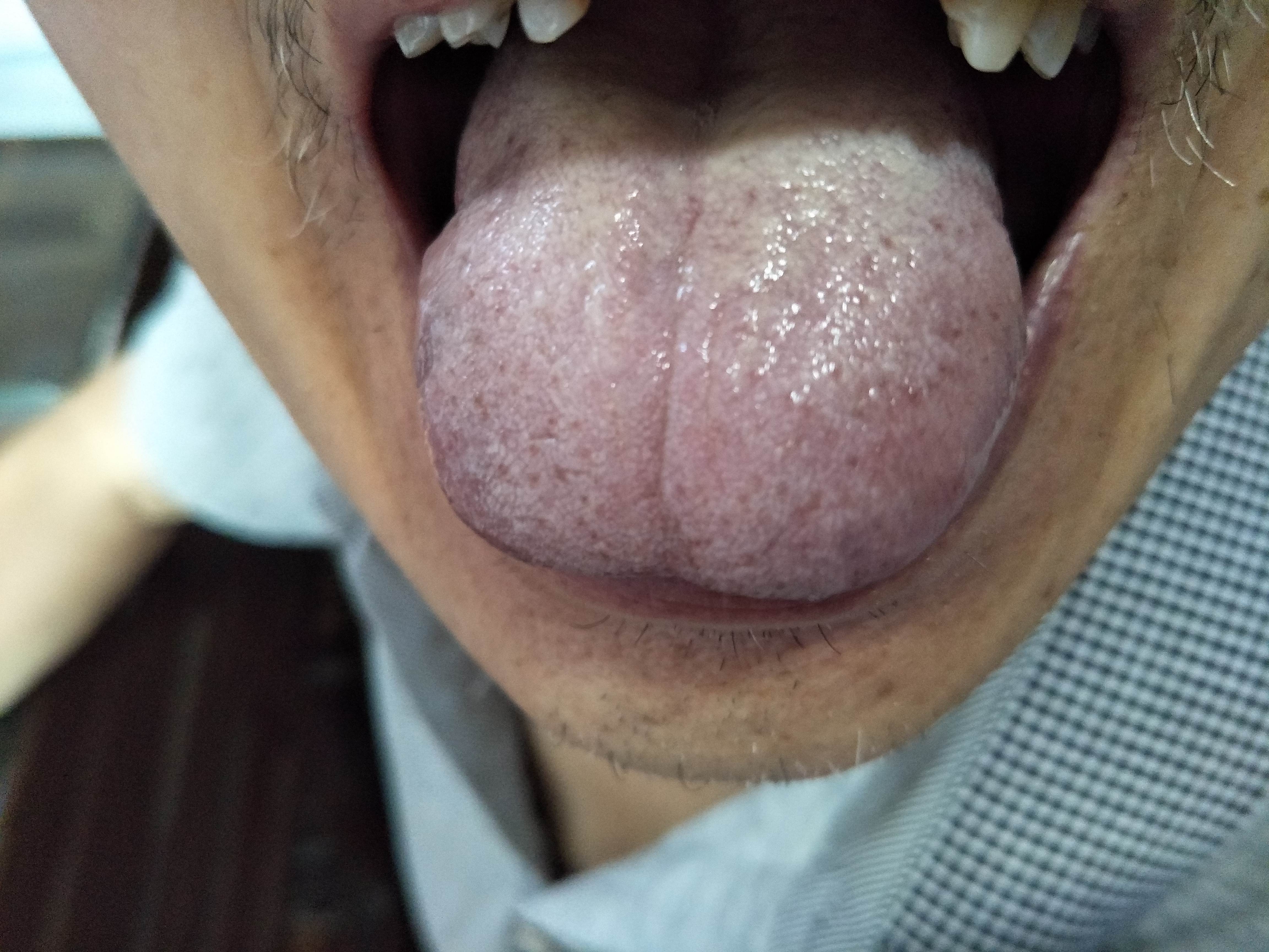 男，67岁，膀胱癌术后1年复发3月 舌面.jpg