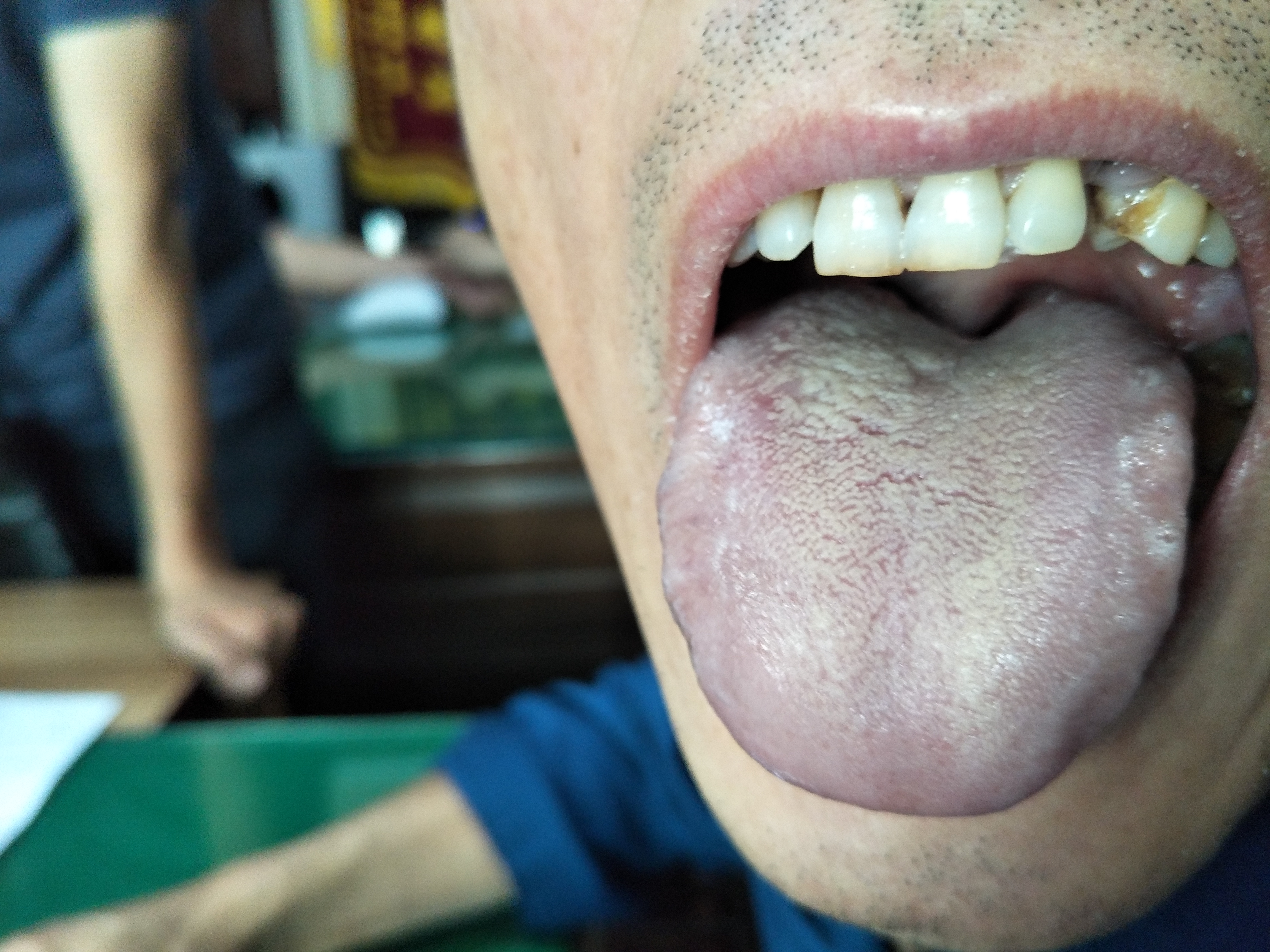 男，57 ，胆管癌术后四年余（舌像）.jpg