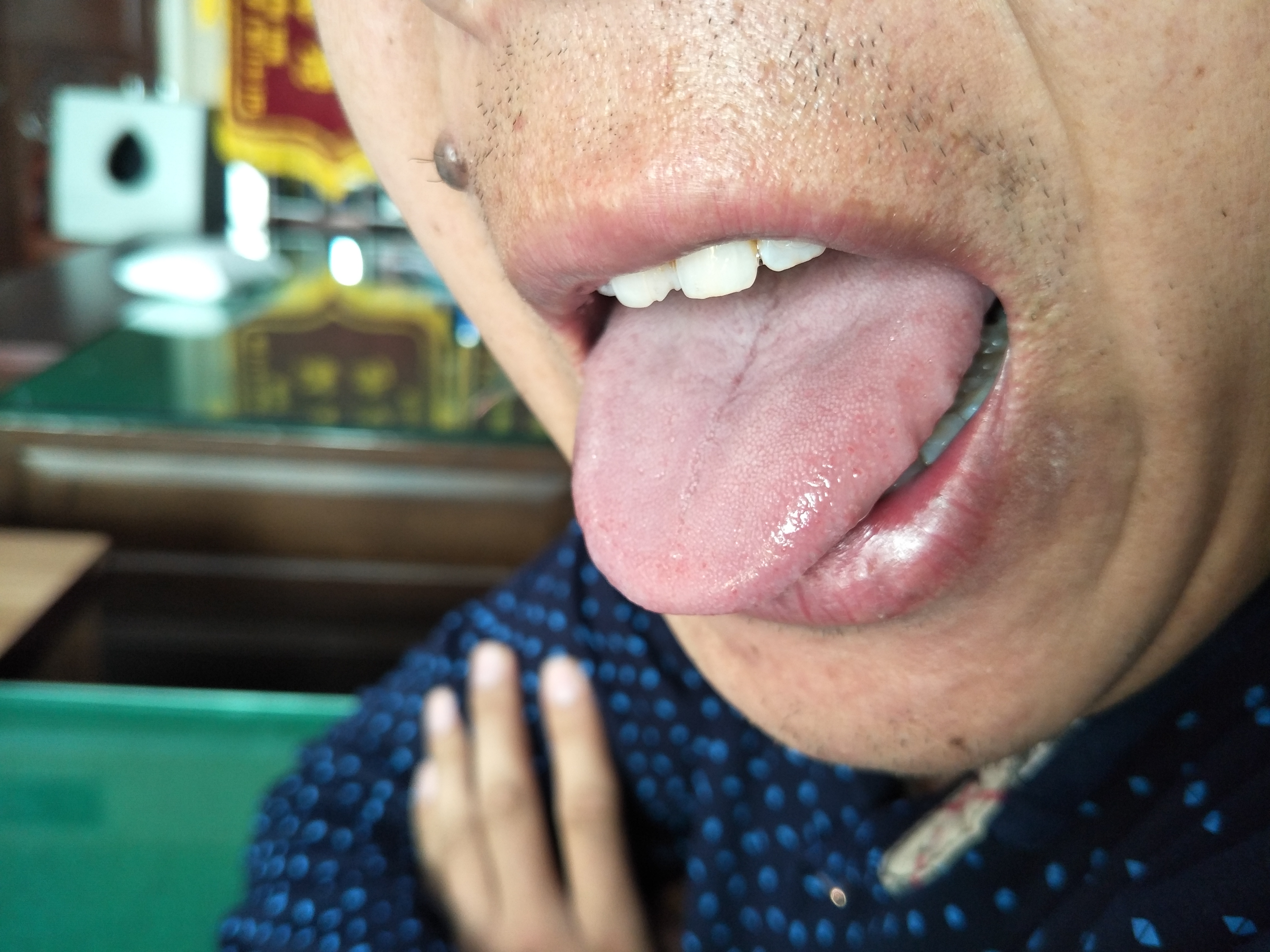 男，39，发现感染乙肝病毒13年余（舌像).jpg