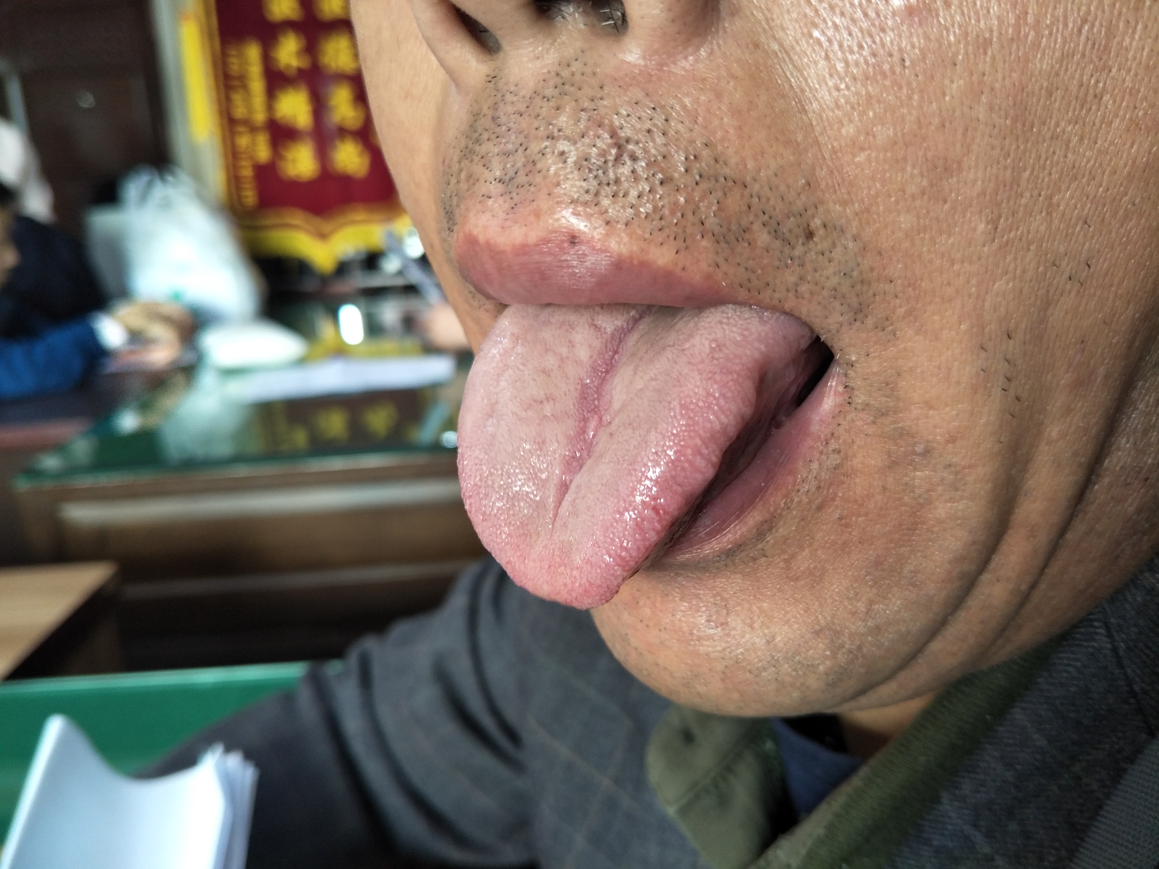 男，55，小便泡沫液2年余(舌像）.jpg