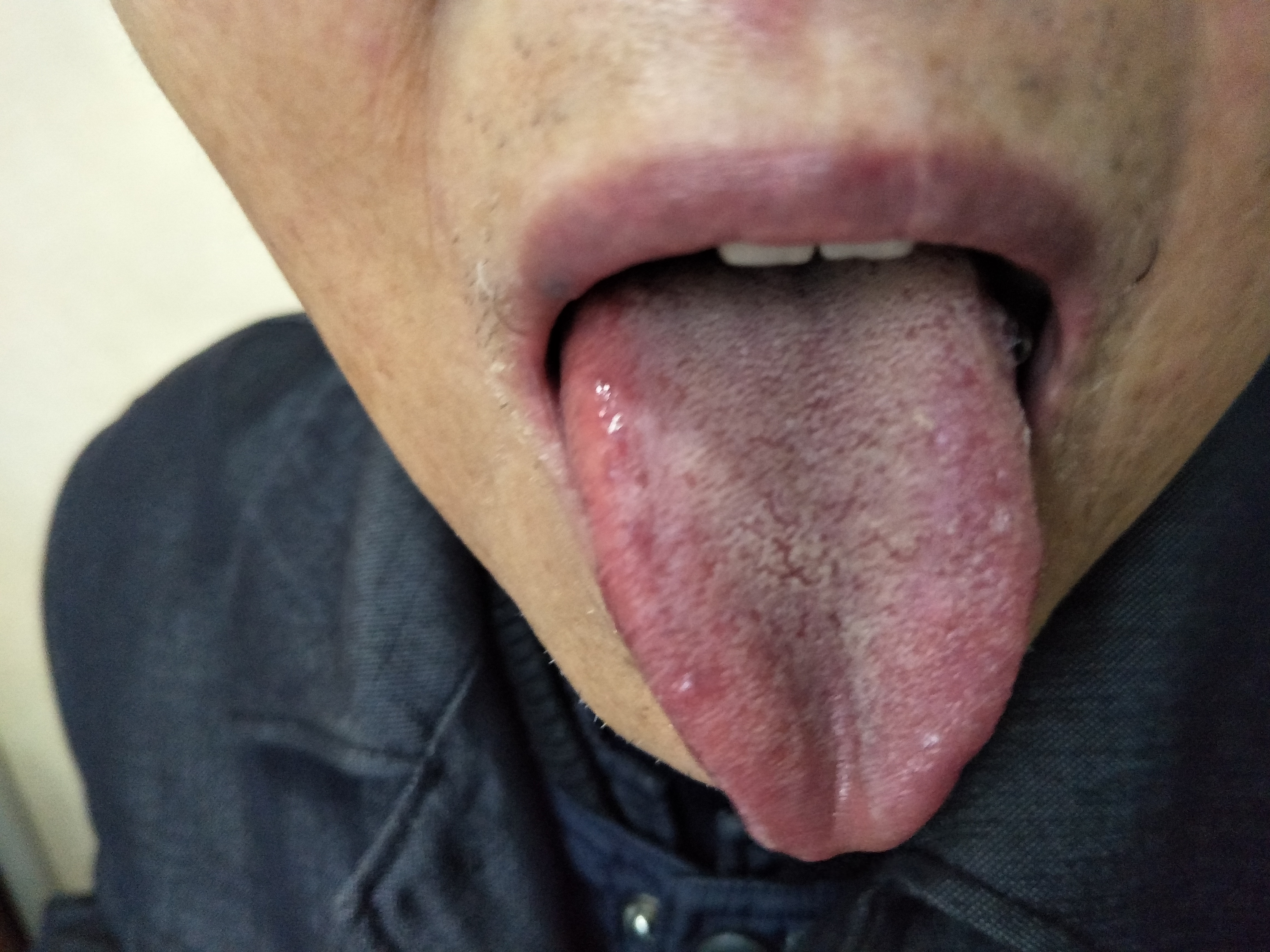 男，75 咳嗽咳痰十余年.jpg