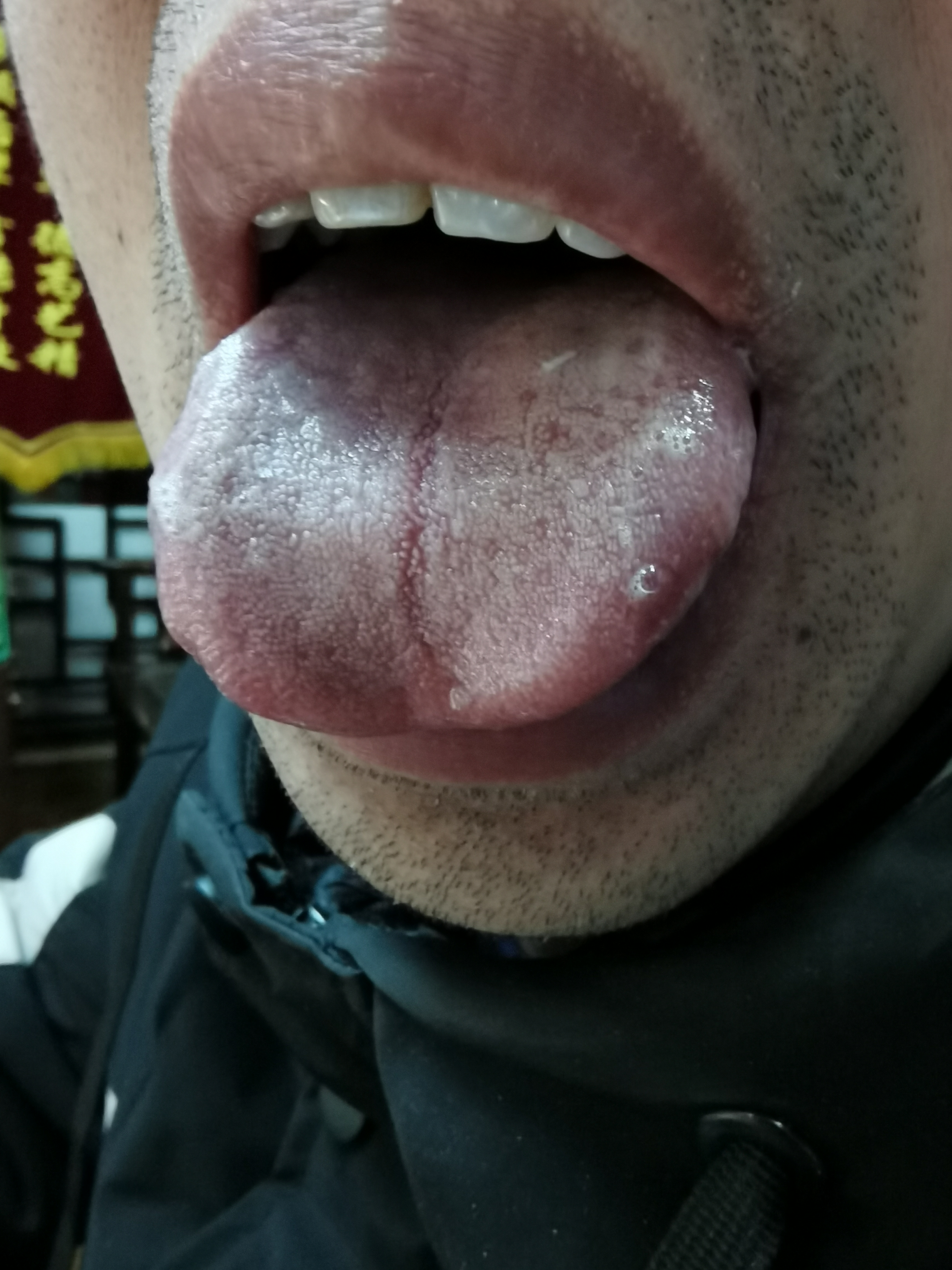男，40，胃脘胀满不适5年.jpg