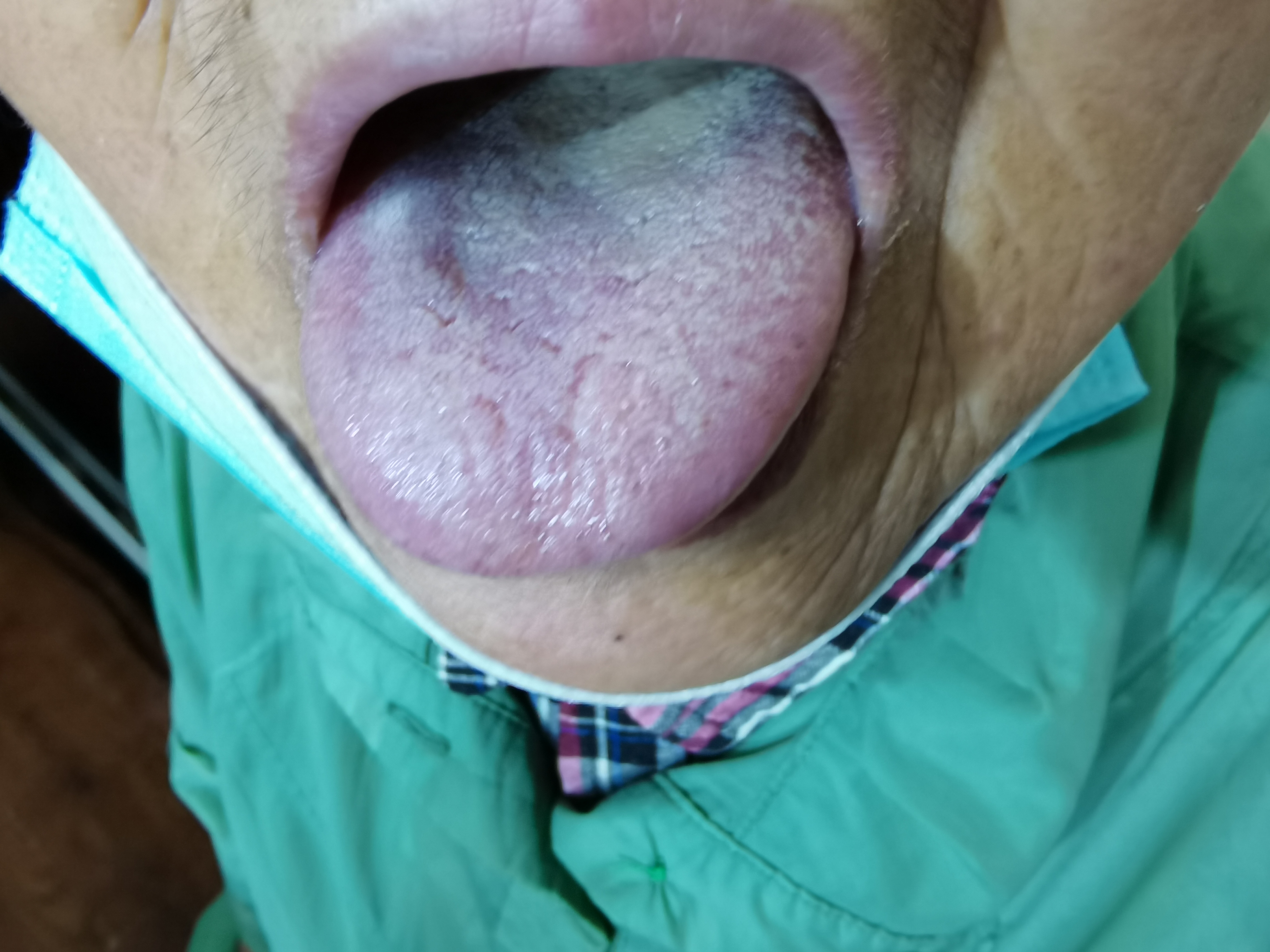 女，76 右乳癌术后半年.jpg