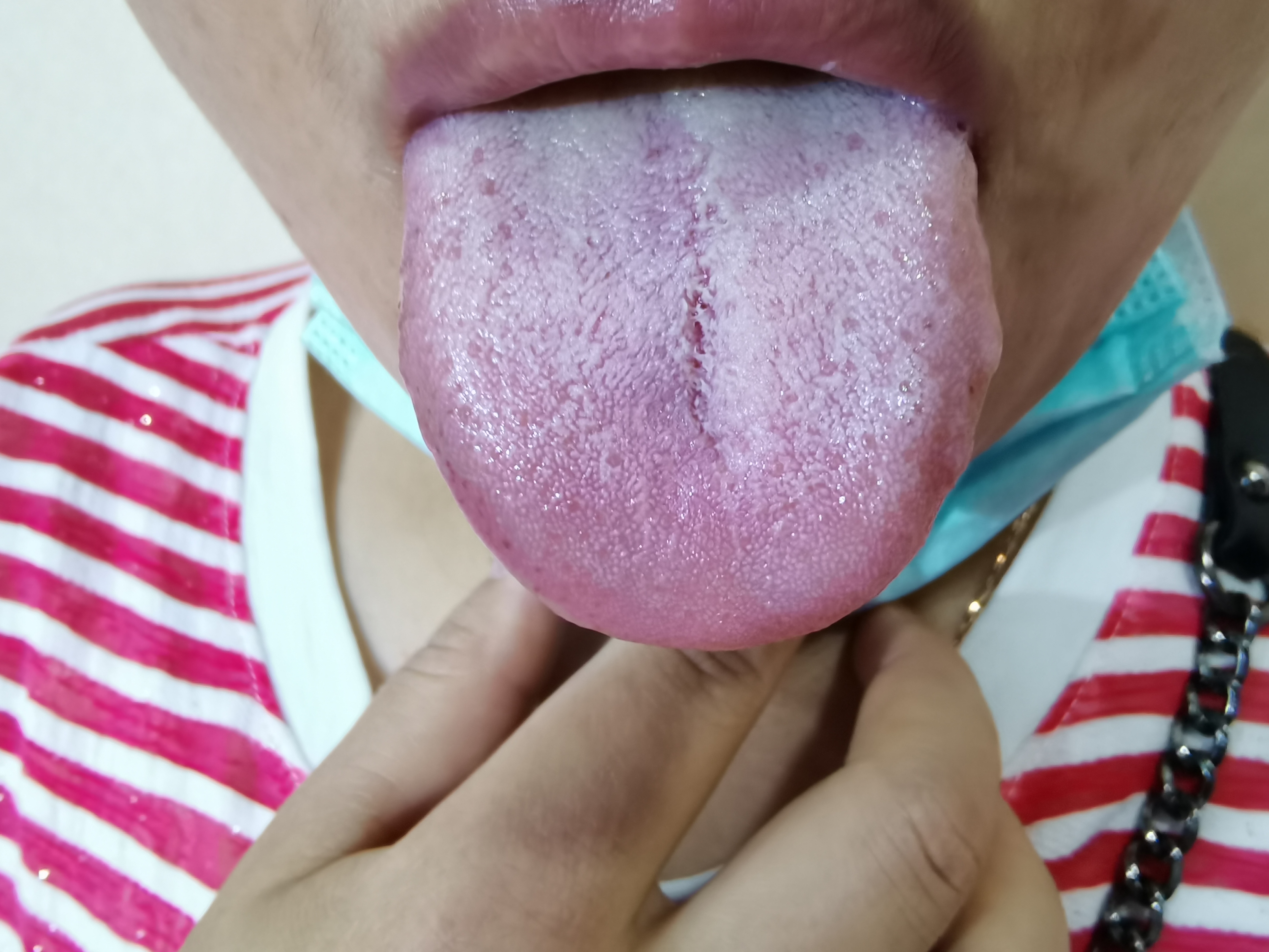 女33 全身关节疼痛5年.jpg