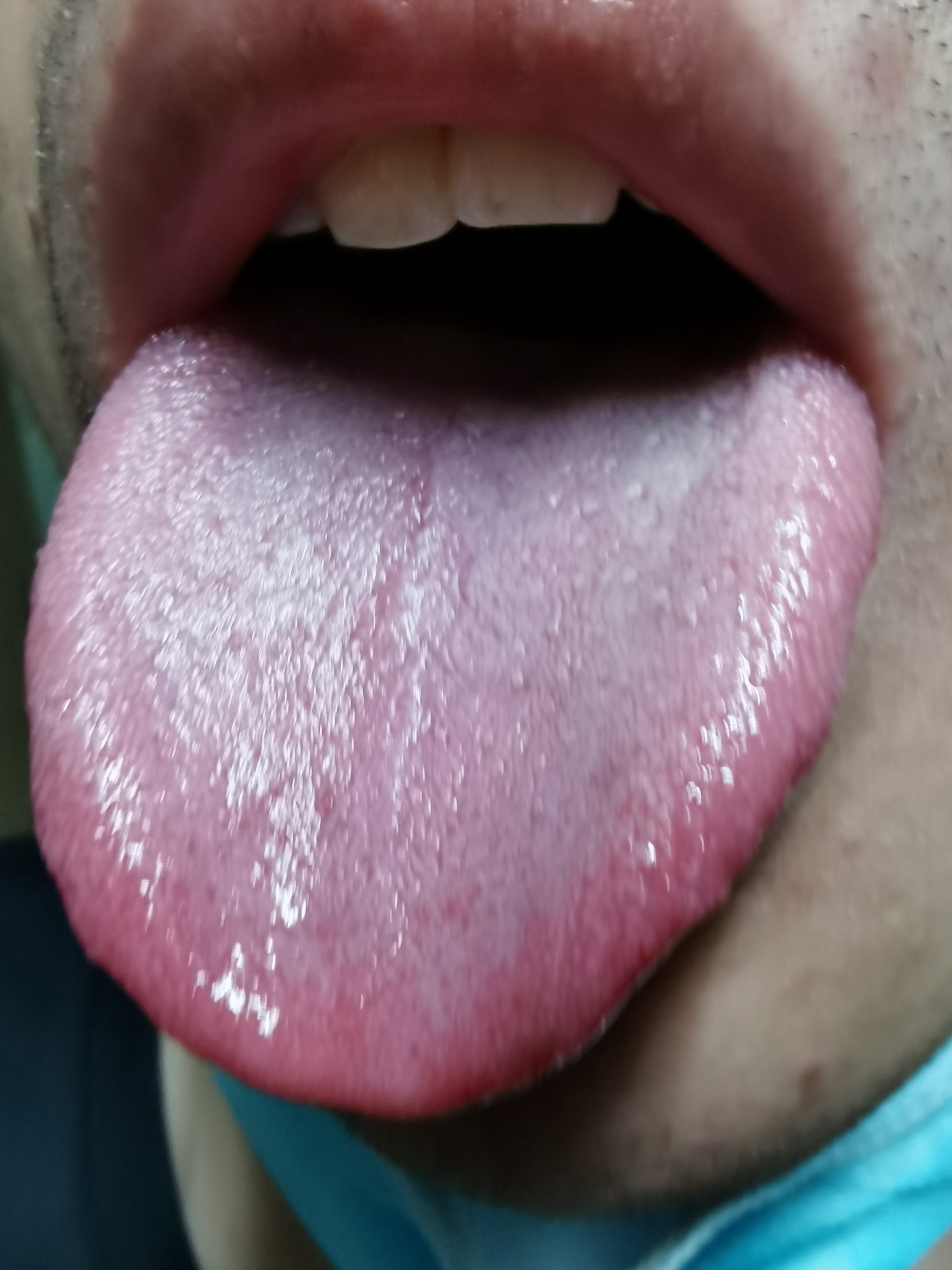 男，25岁，双下肢乏力4年 舌诊.jpg