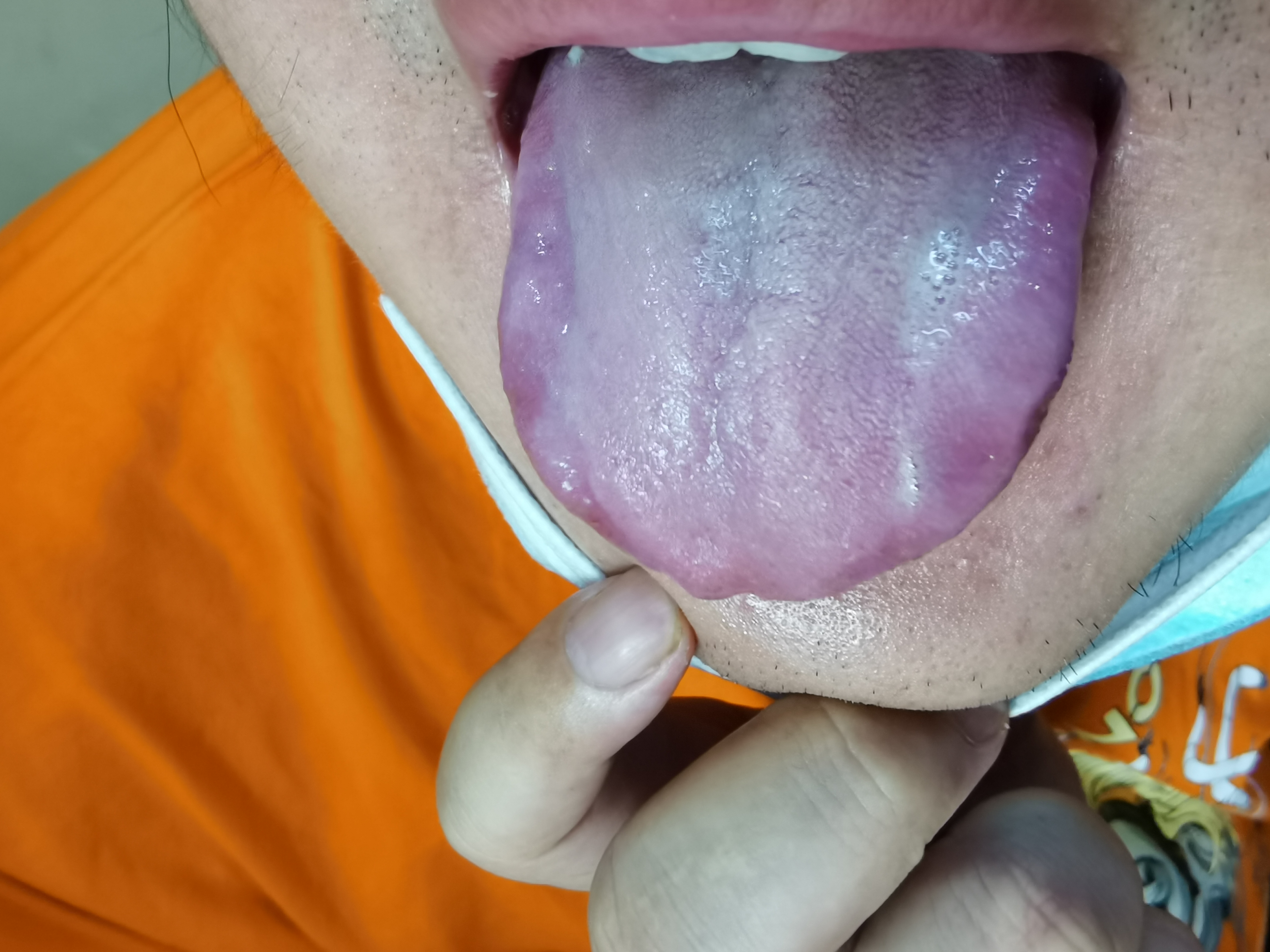 男，31岁双下肢肌肉萎缩8年余，呈渐进性加重 舌面.jpg