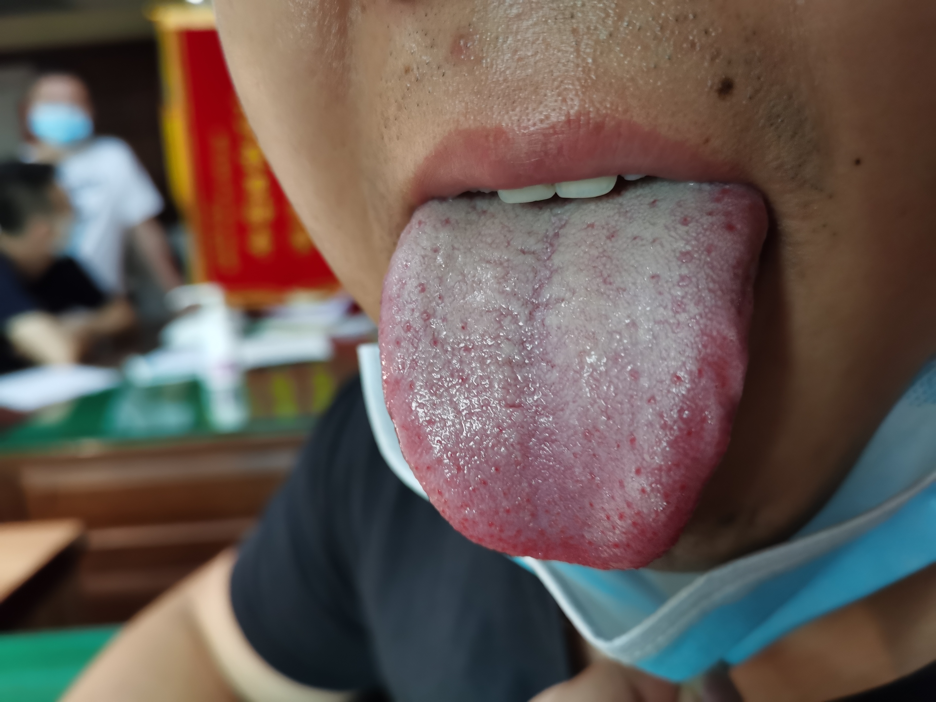 男，32岁，胃脘部隐隐不适1年余 舌面.jpg