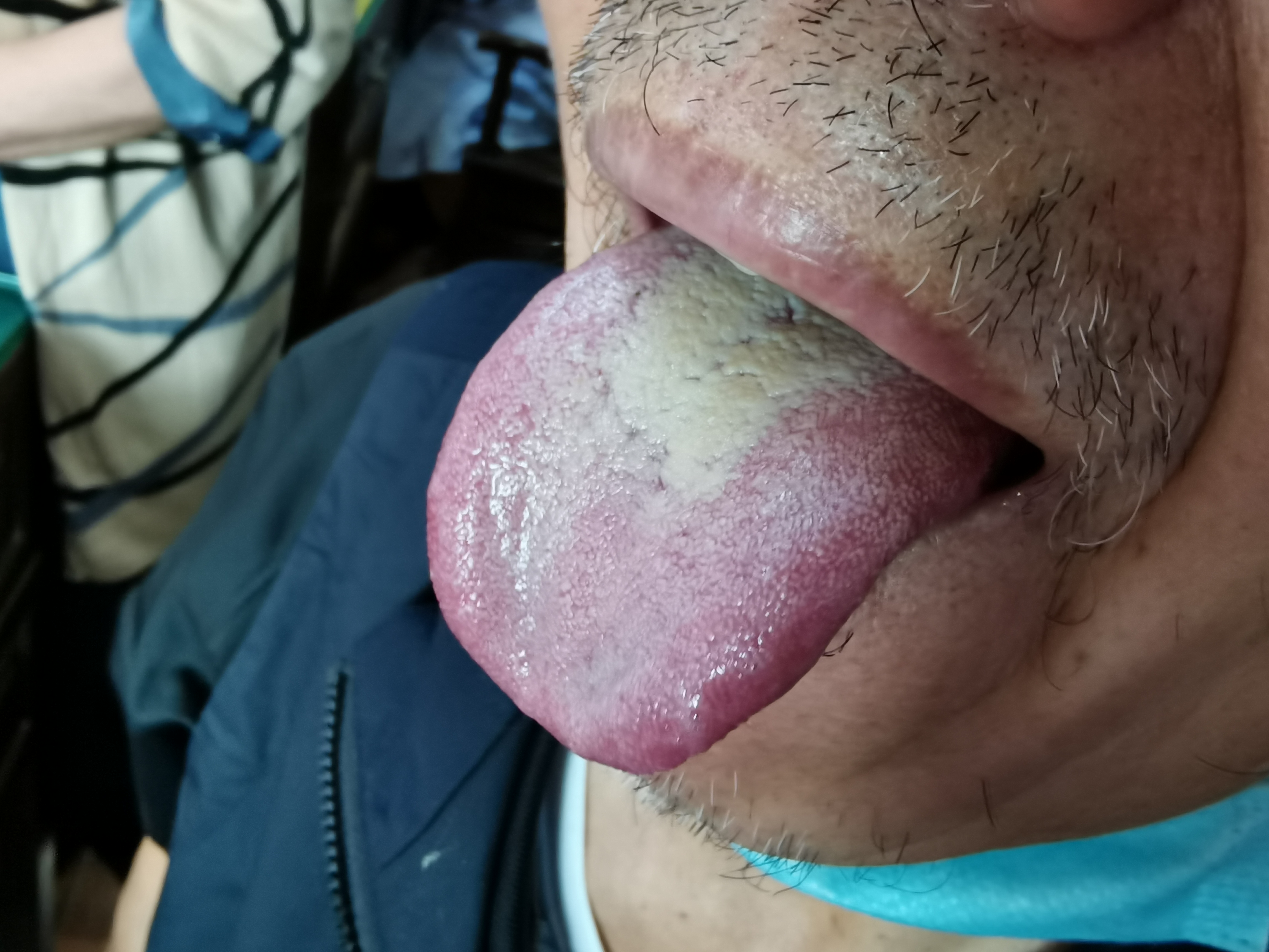 男，37，发现贲门胃底癌5月余 舌面.jpg