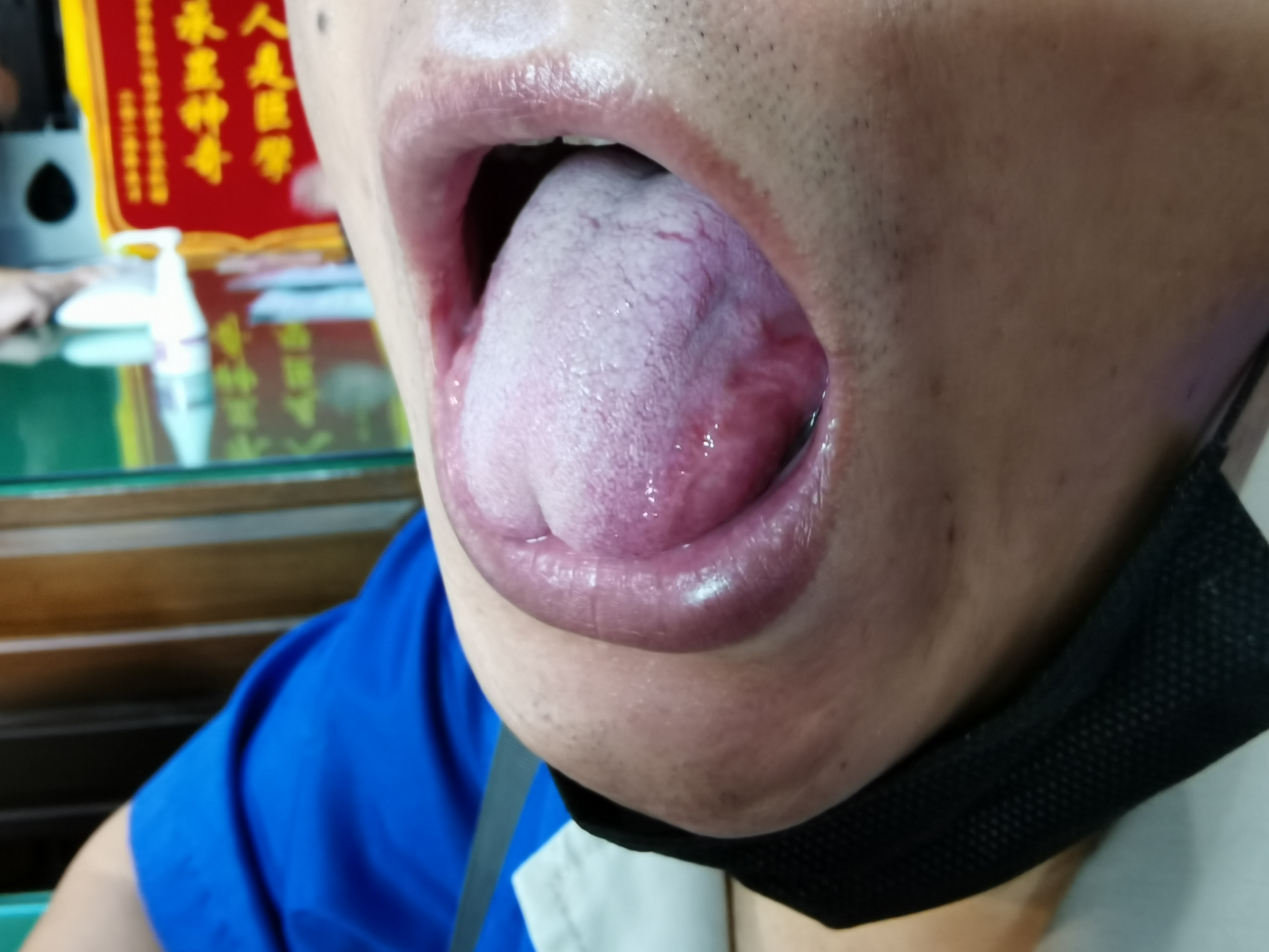 男，50岁，全身肌肉酸胀疼痛6年余 舌面.jpg