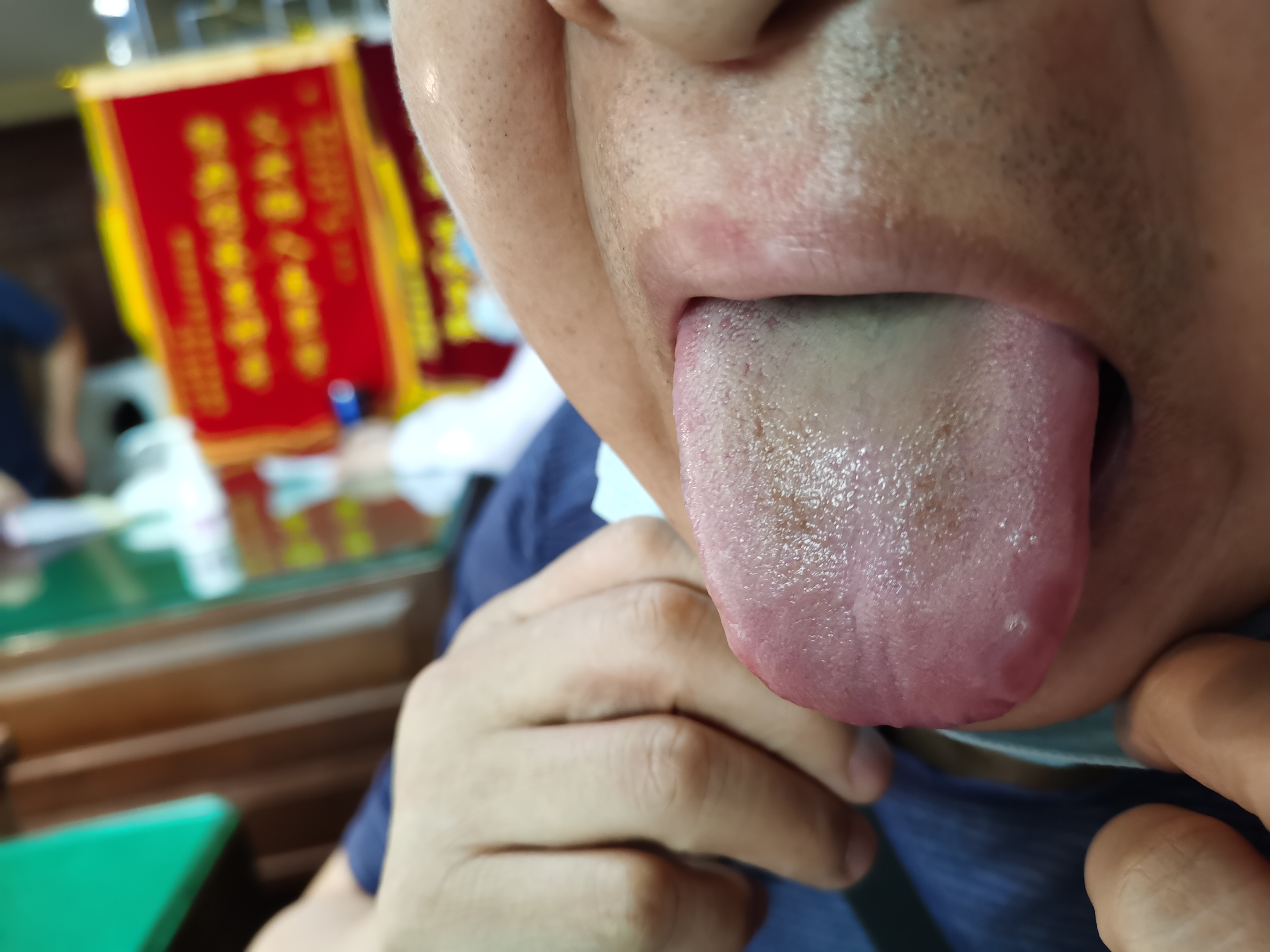 男，51岁，耳鸣7年余 舌面.jpg