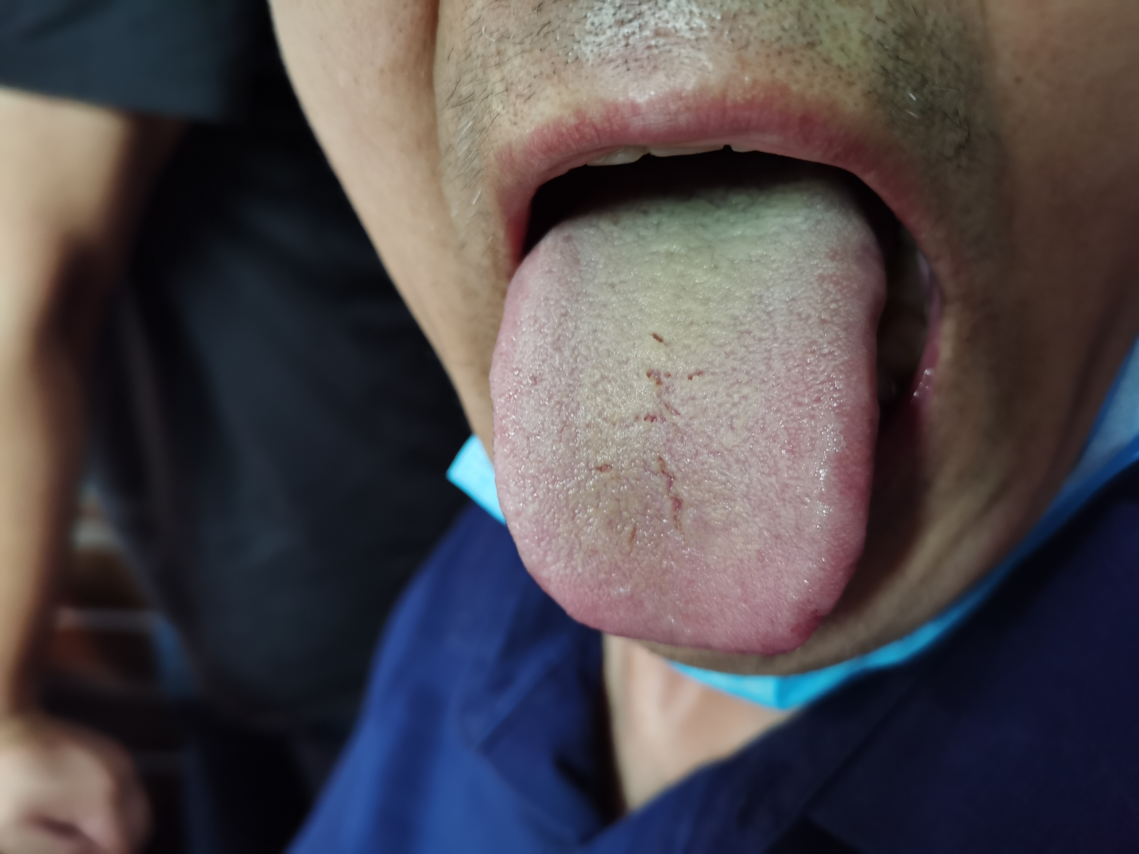 男，60岁，发现胰腺癌7月余，术后发生转移，化疗11次 舌面.jpg