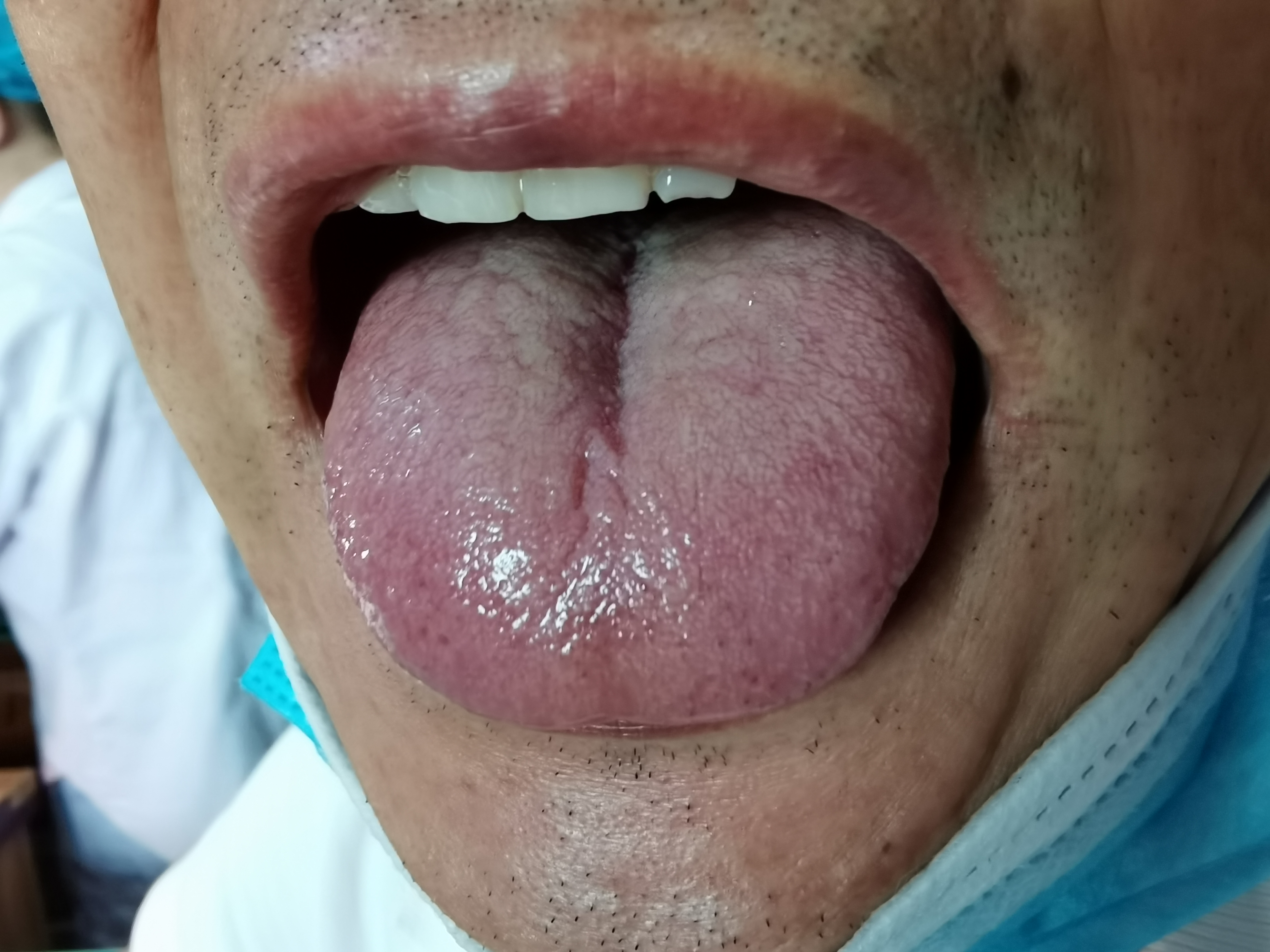 男，63，头晕耳鸣1年 舌面.jpg