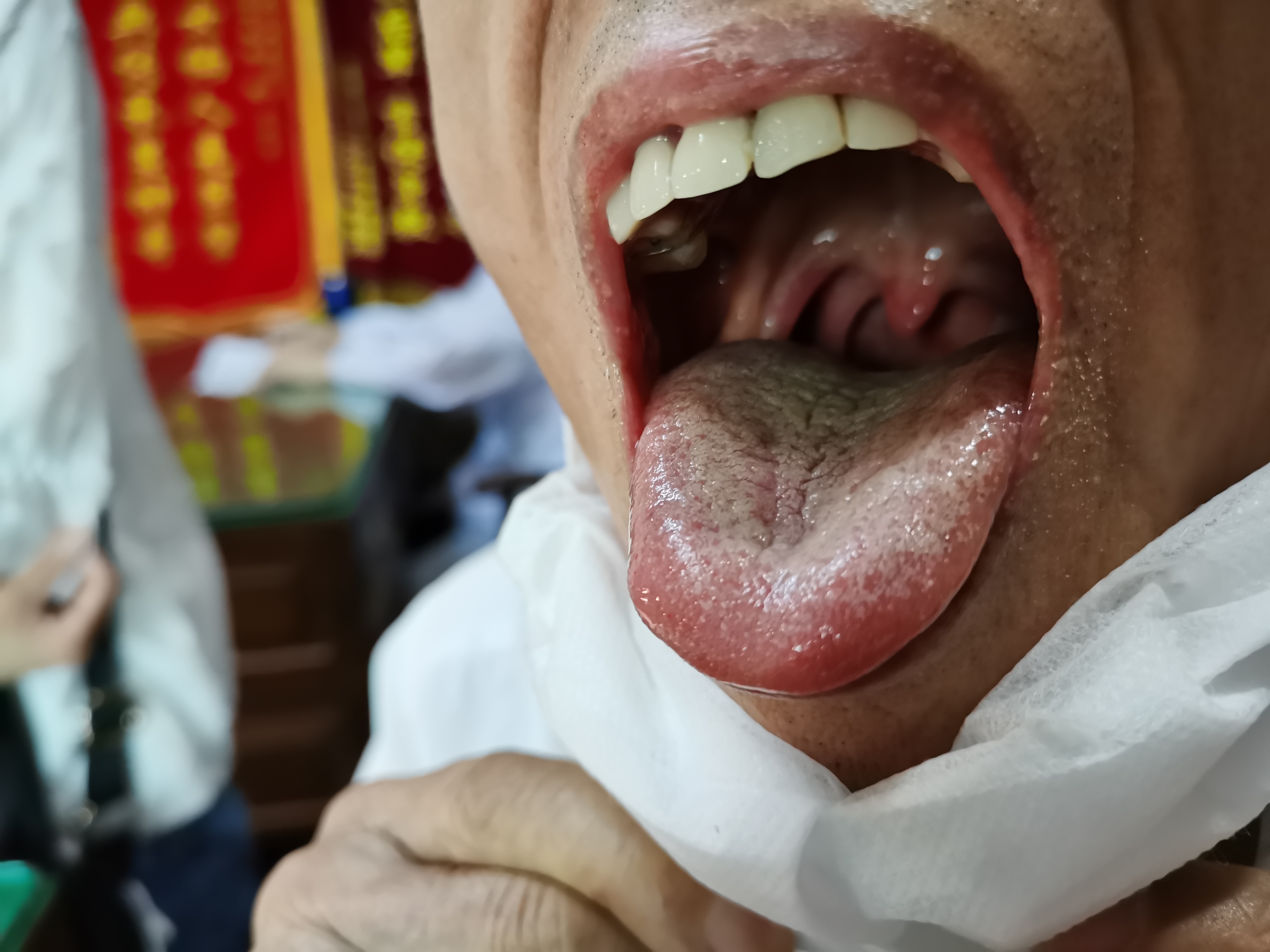 男，70岁，反复咳嗽咳痰20余年 舌面.jpg