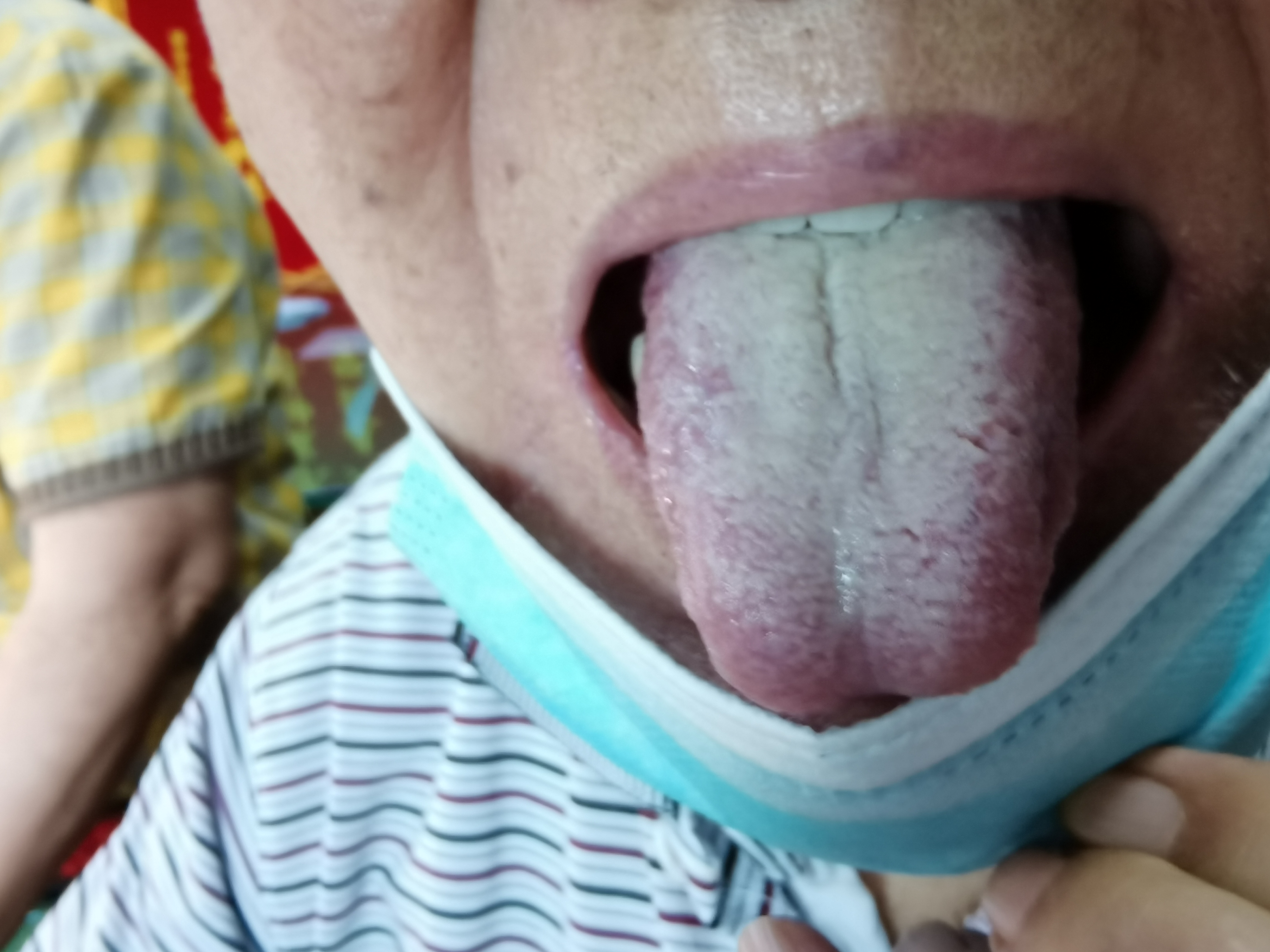 男，83岁，肺癌化疗3月 舌面.jpg