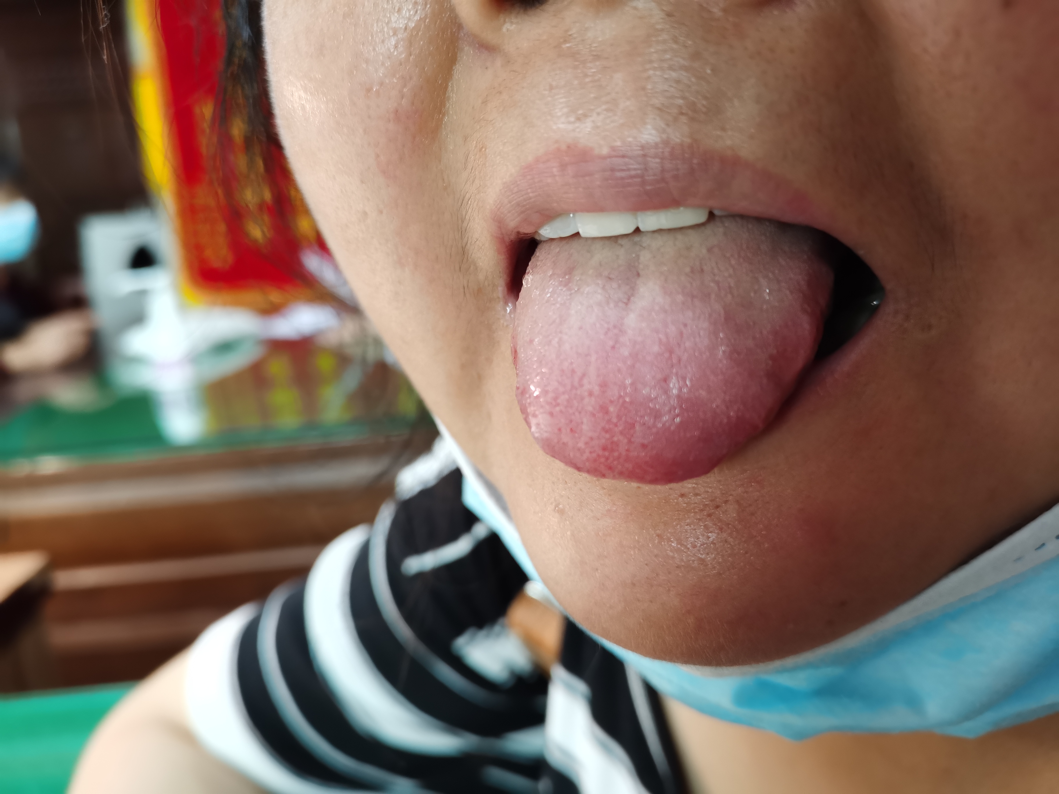 女，31岁，四肢麻木乏力2年余，加重2个月 舌面.jpg