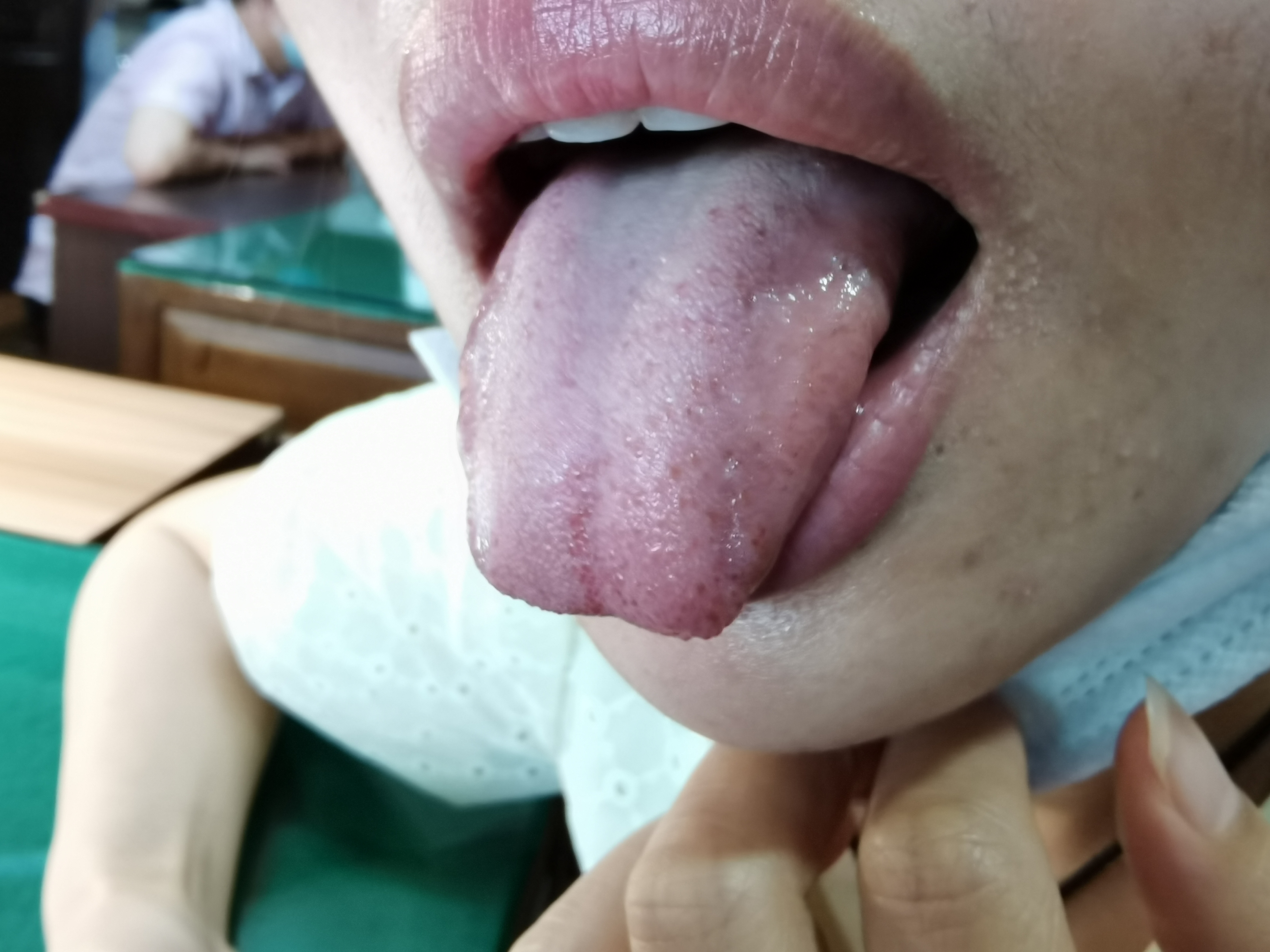 女，32岁，大便偏干3年余 舌面.jpg