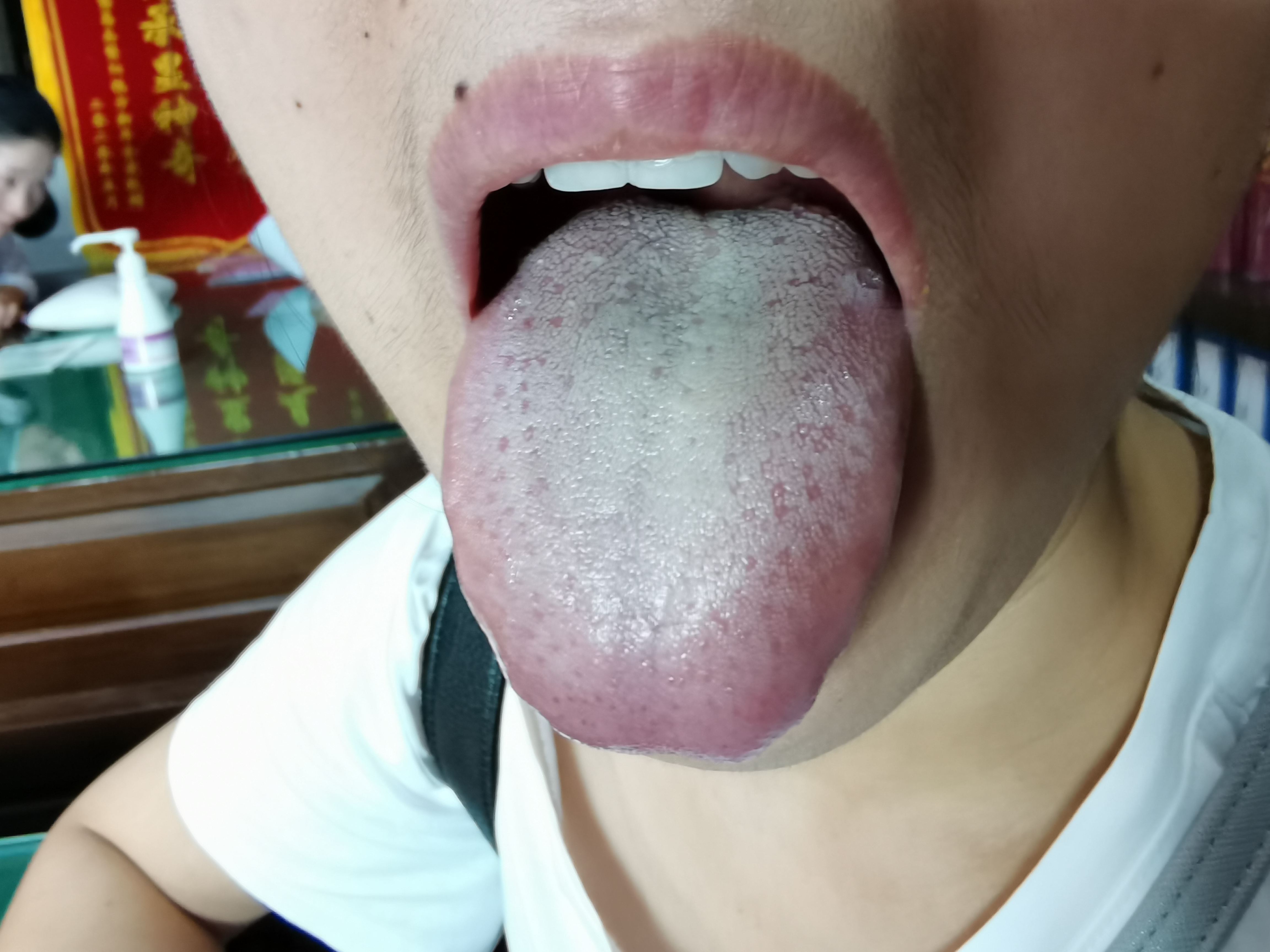 女，36岁，反复上腹部不适2年 舌面.jpg