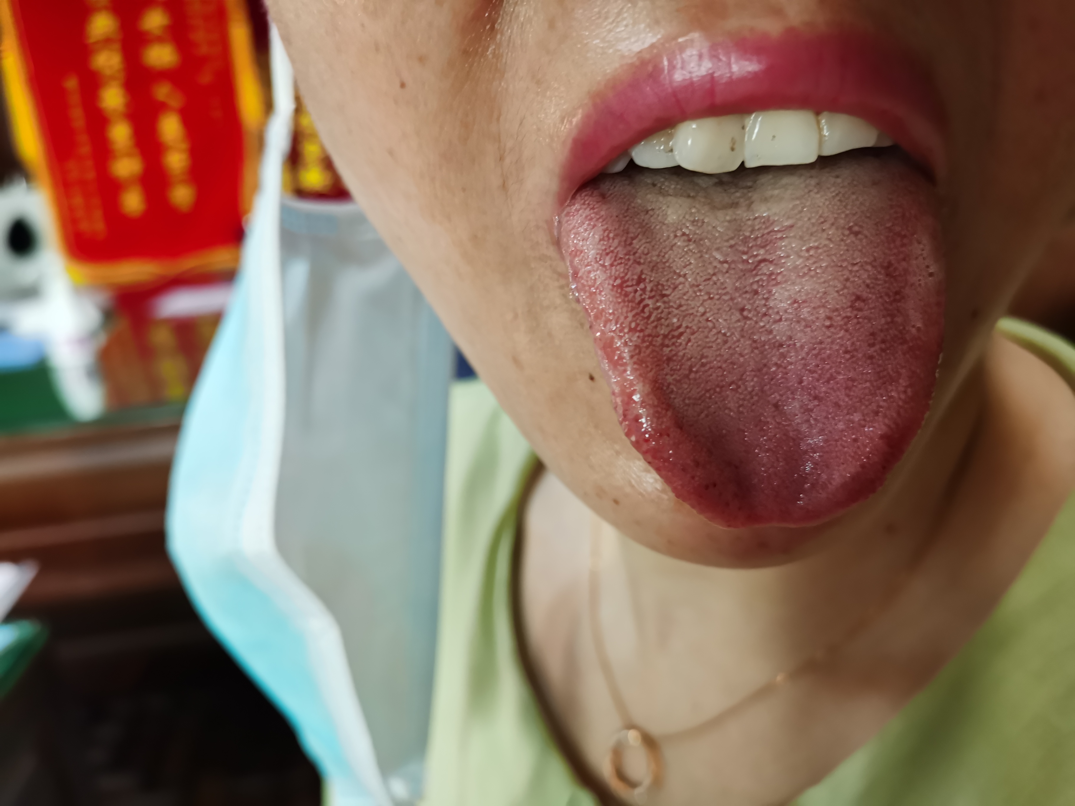 女，39岁，四肢肌肉渐进性萎缩4年余 舌面.jpg