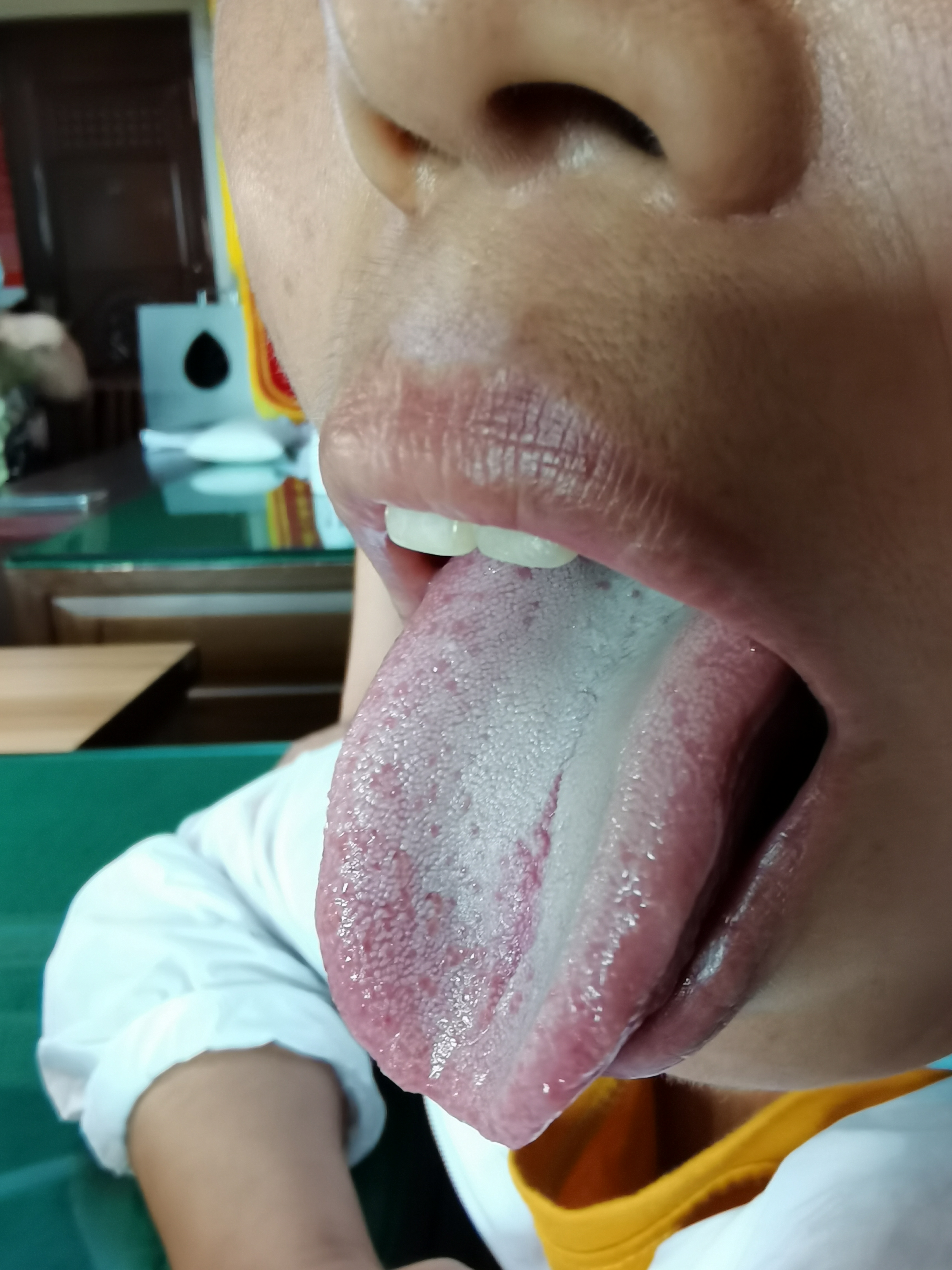 女，50岁，左侧乳腺恶性肿瘤术化后5月余 舌面.jpg