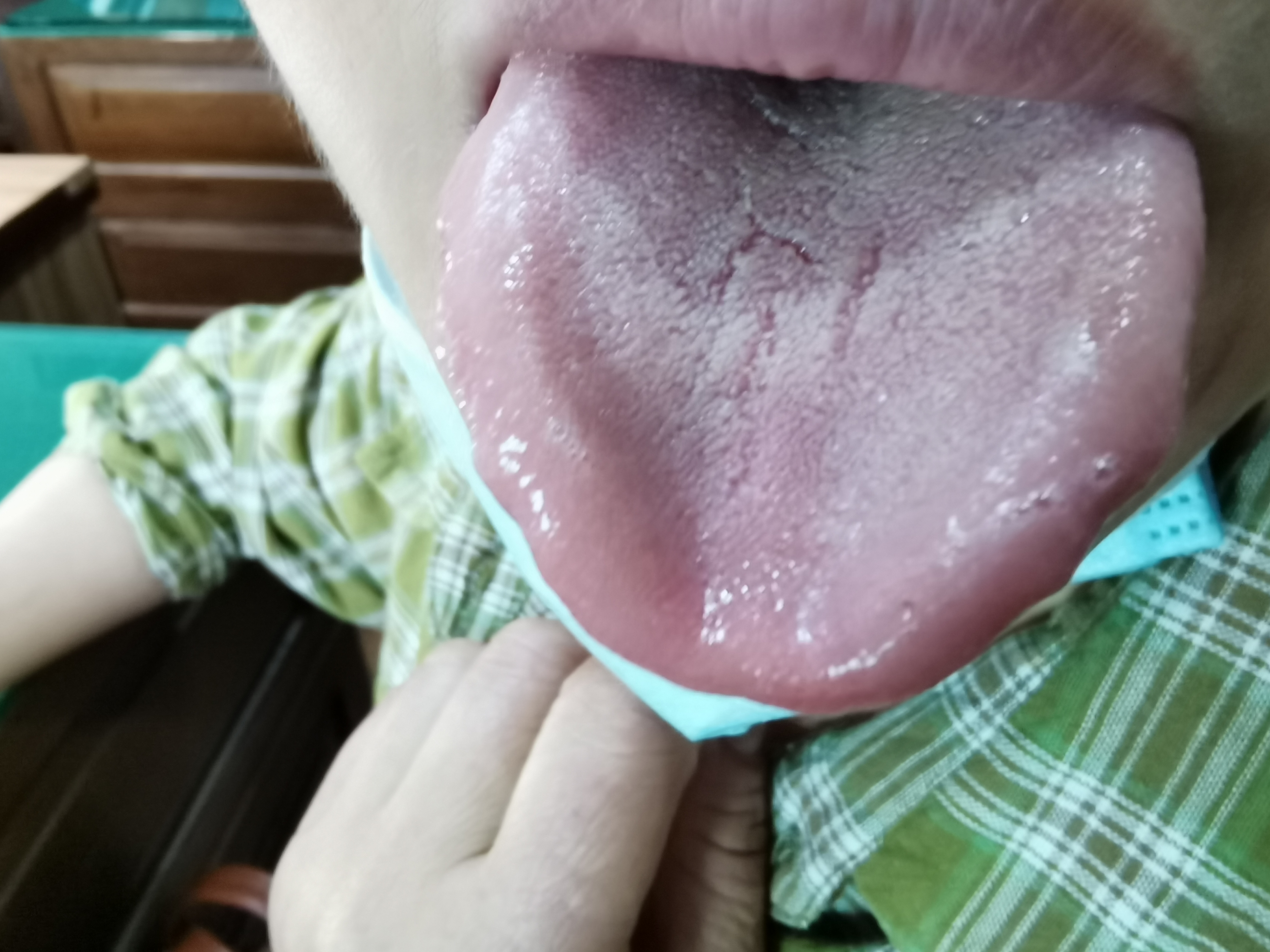 女，51岁，头晕1年，潮热半年 舌面.jpg