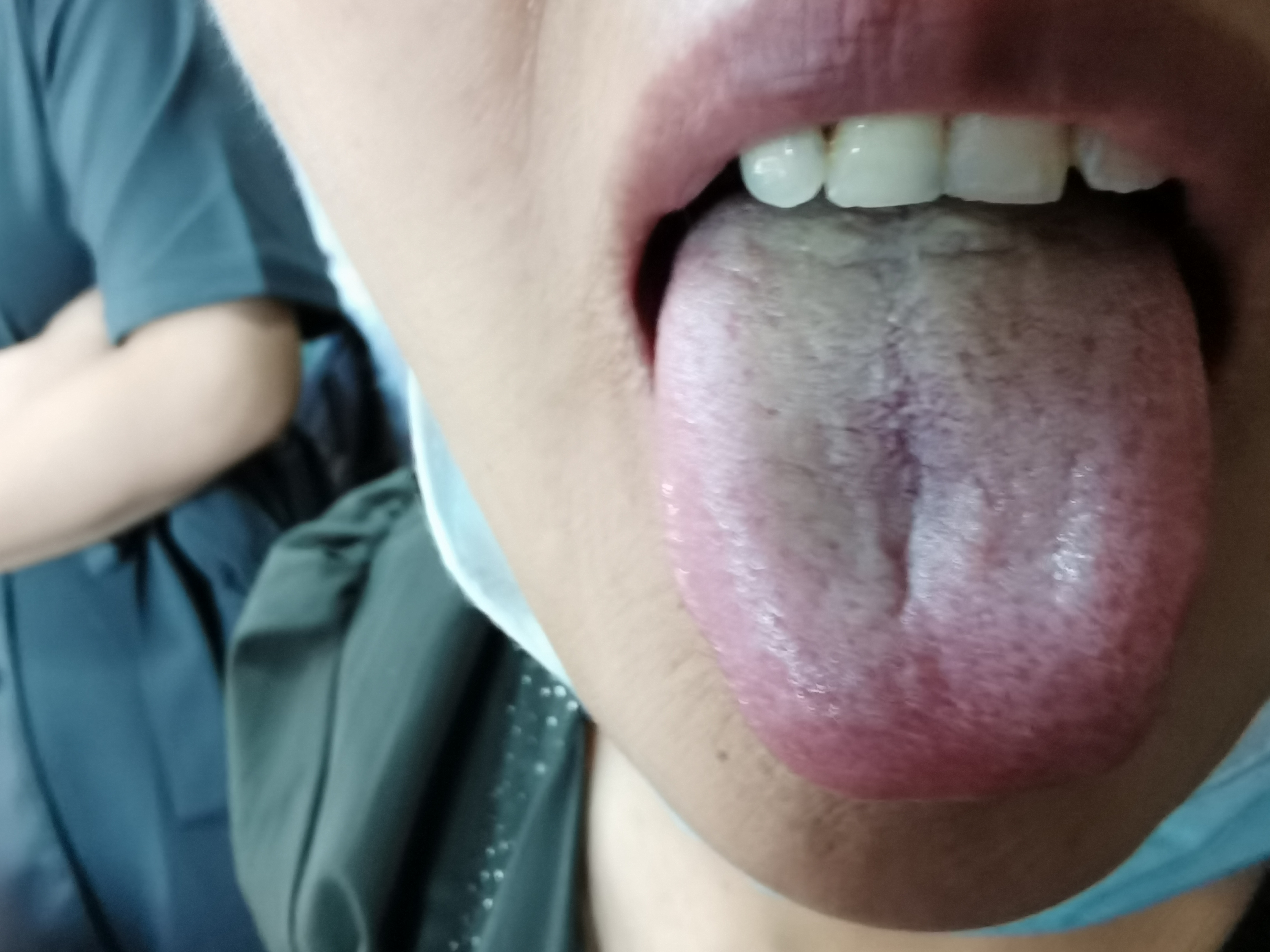 女，56岁，头部外伤1年余，按压出现嗳气，头晕 舌面.jpg