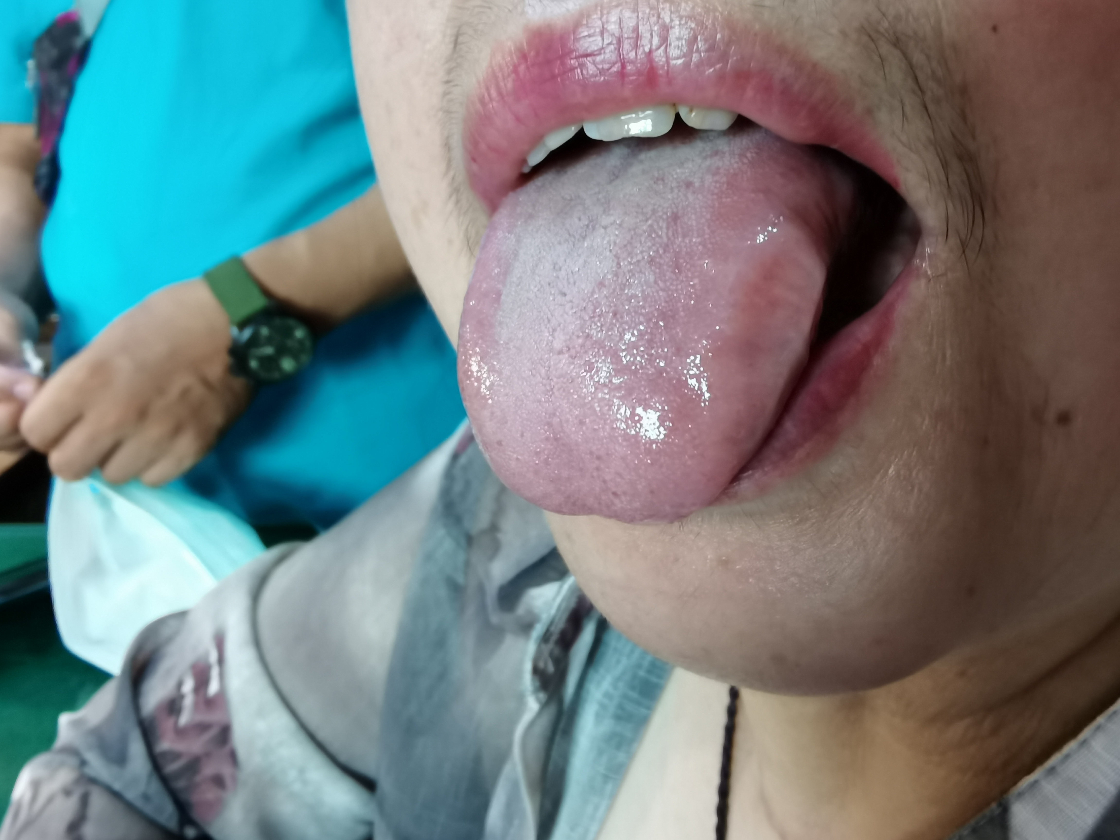 女，56岁，周身结结较多6年余 舌面.jpg