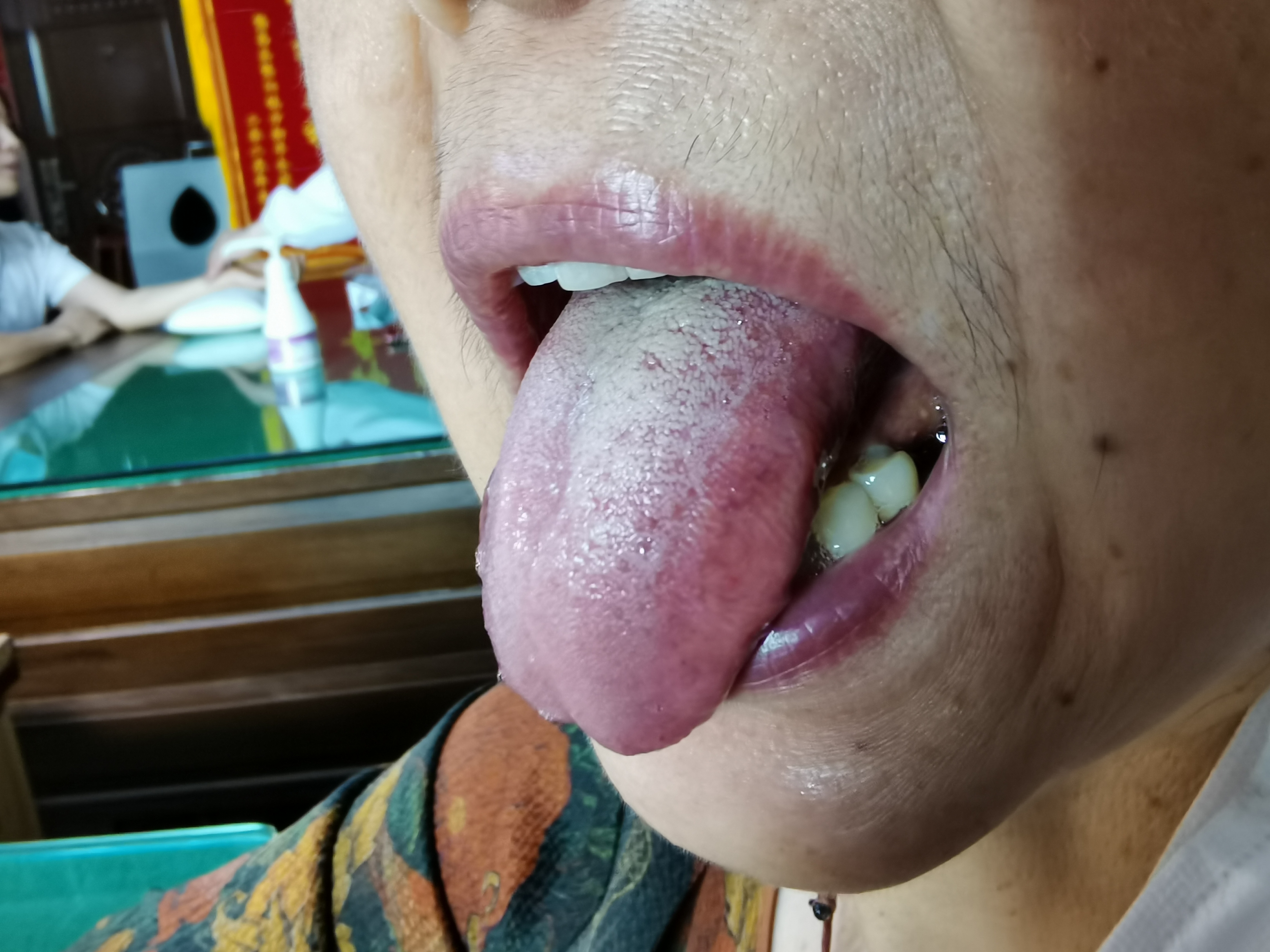 女，61岁，胃脘部胀痛不适3月余 舌面.jpg