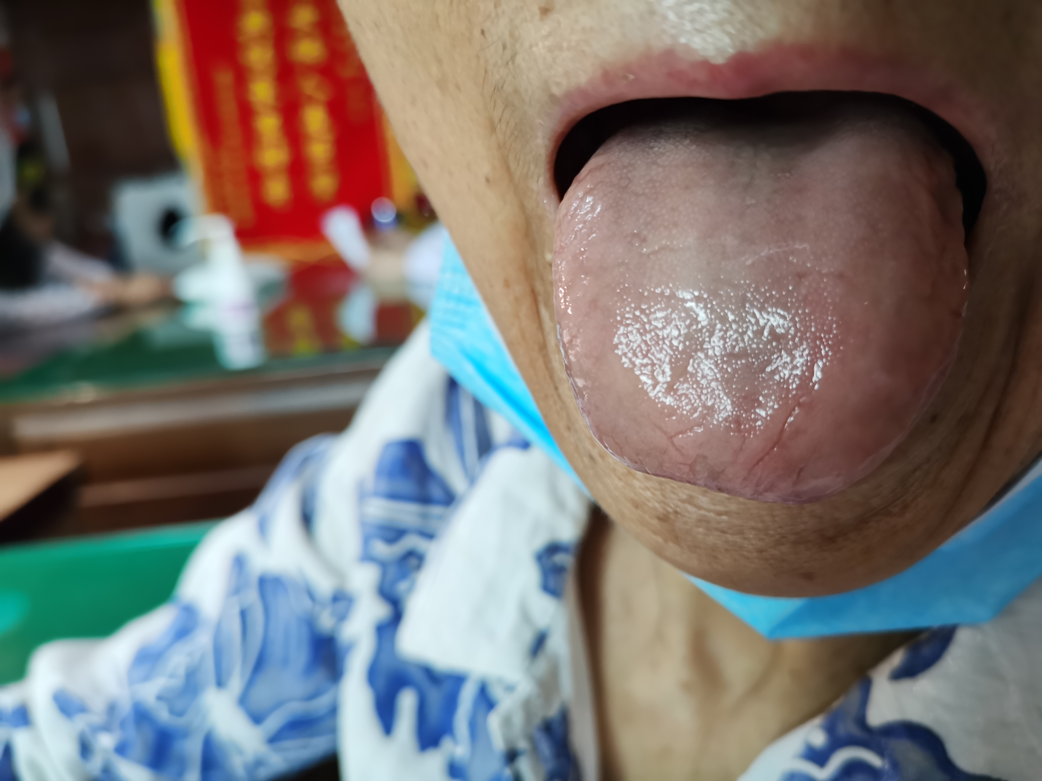 女，75岁，反复心慌胸闷近十年 舌面.jpg