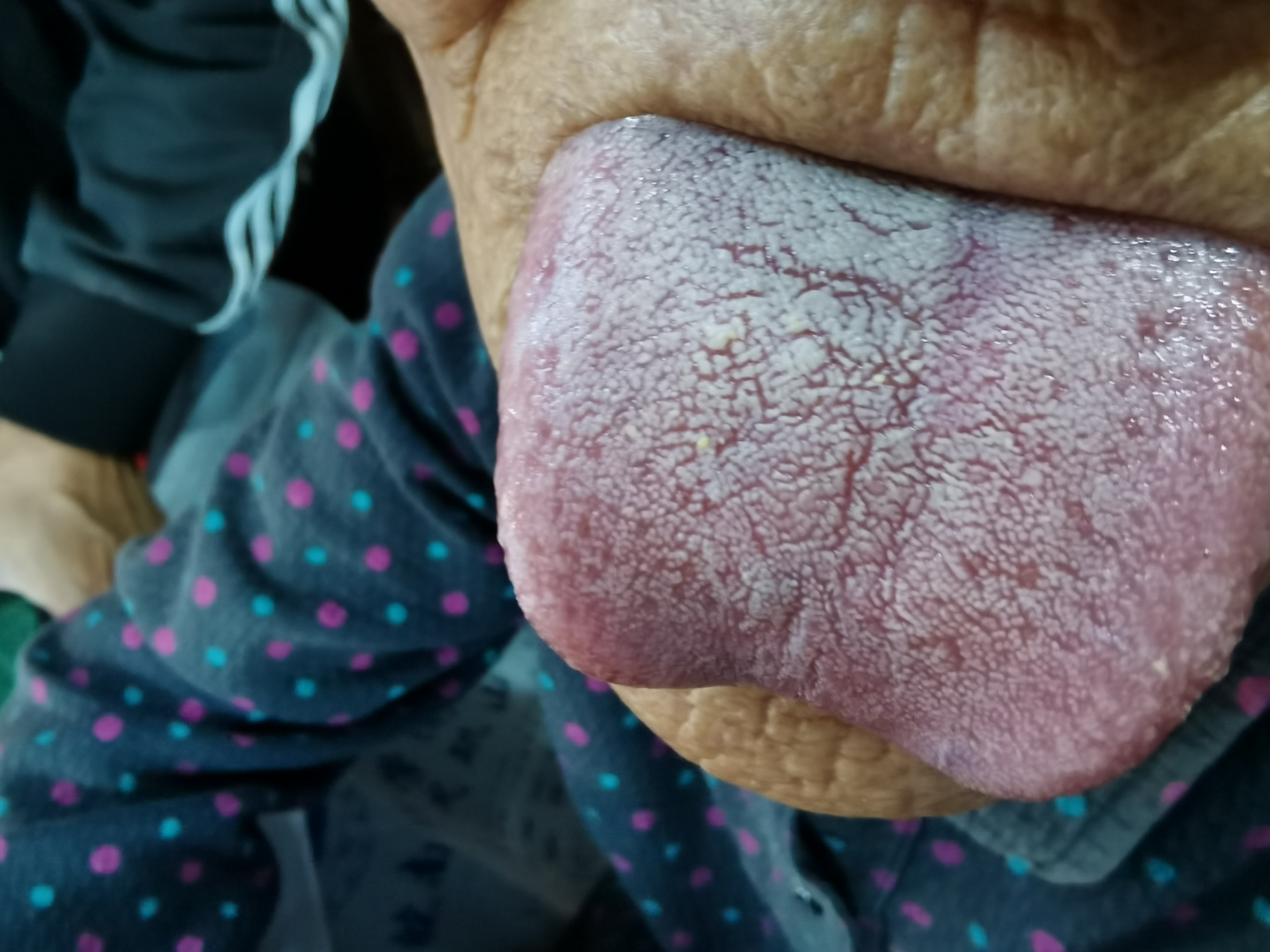 女，90岁，脑鸣3年 舌面.jpg