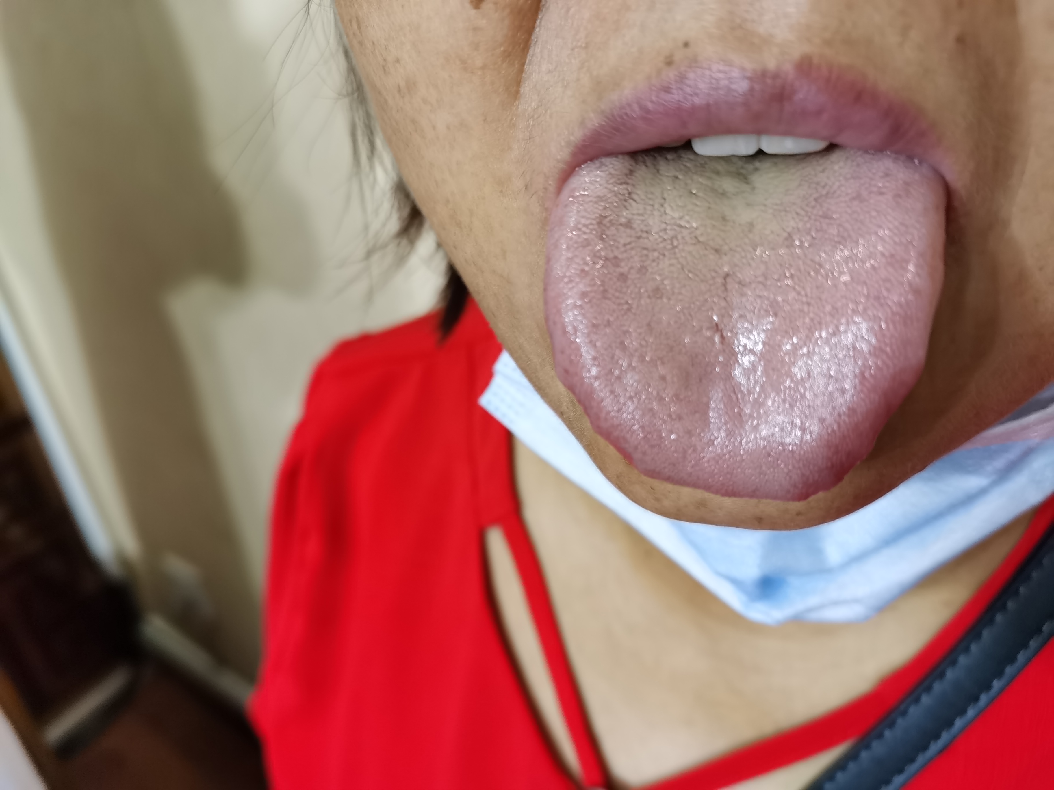 女，48 双下肢水肿十年.jpg