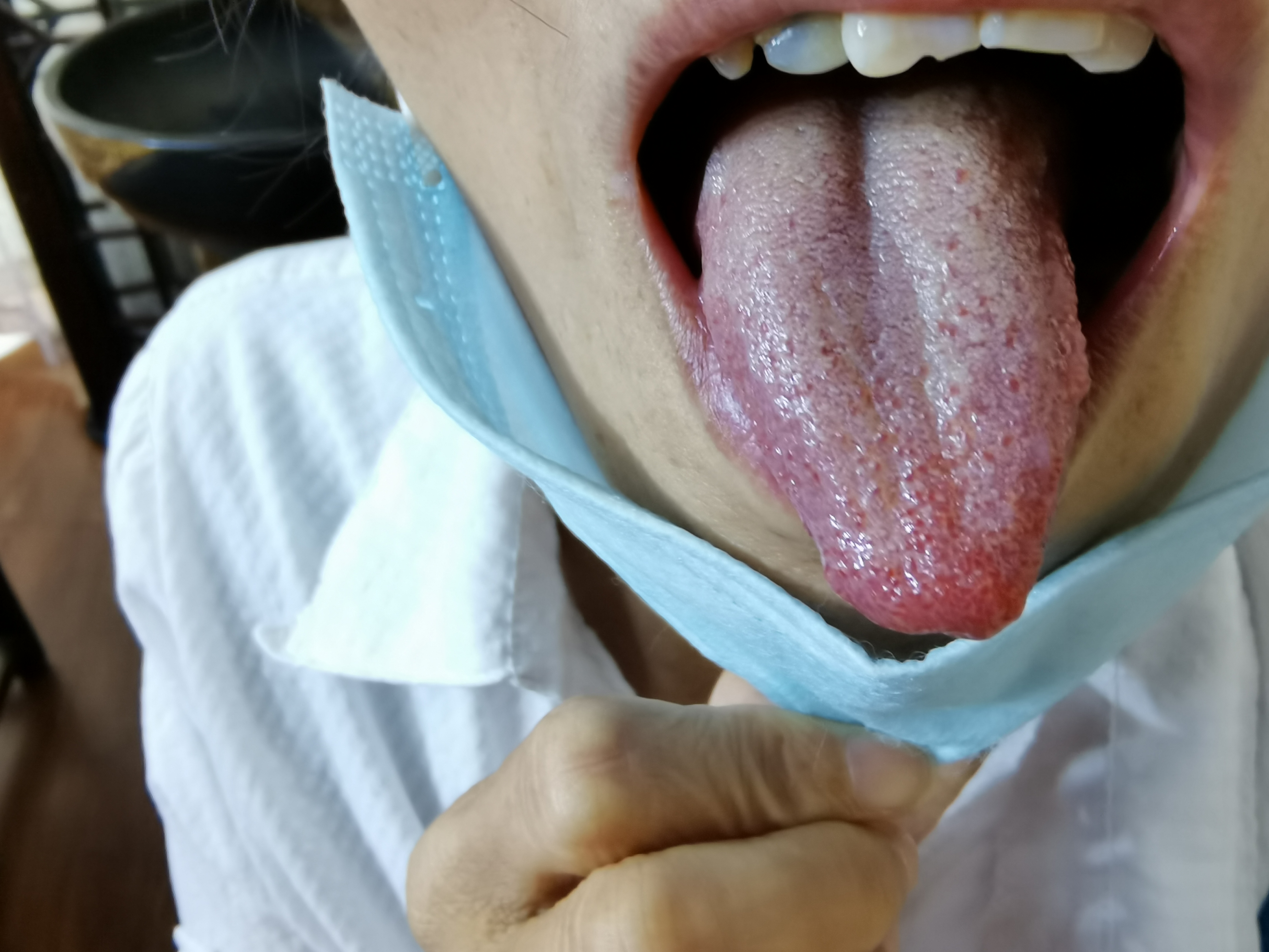 女，56 胃脘部胀痛不适一年.jpg