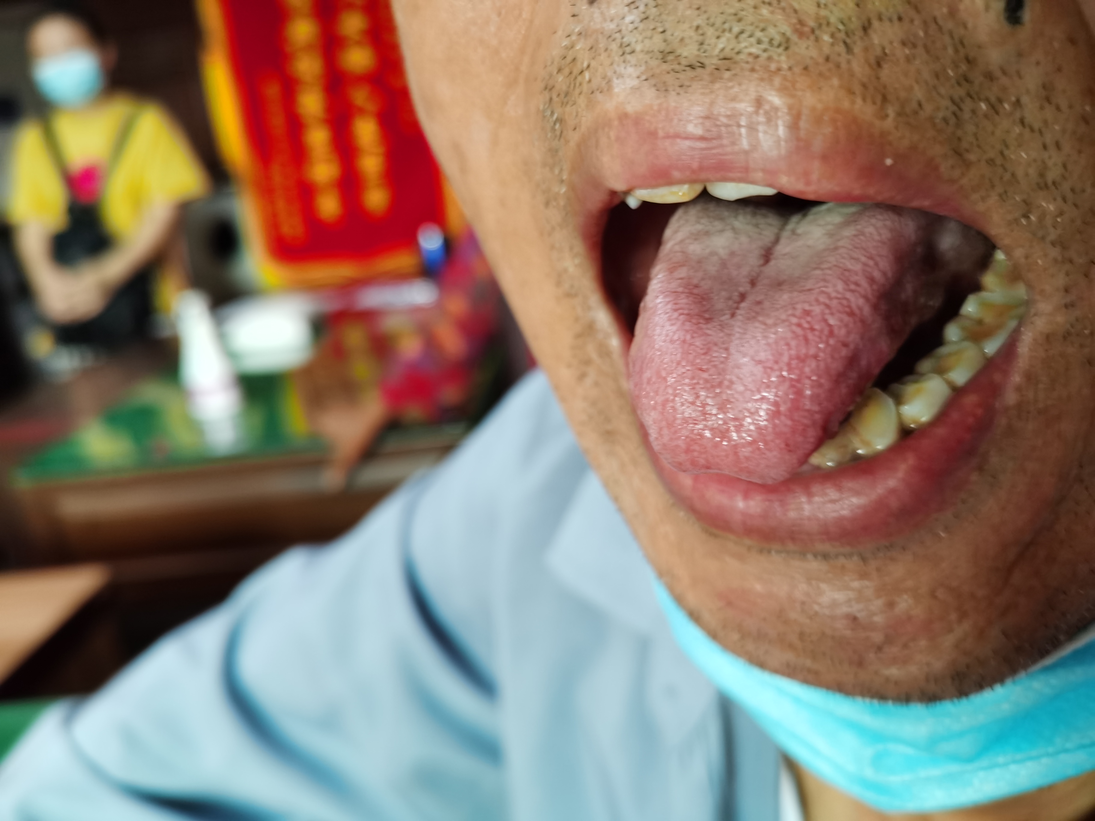 男，70岁，左肺鳞癌术后5年，咳嗽气喘2年 舌面.jpg