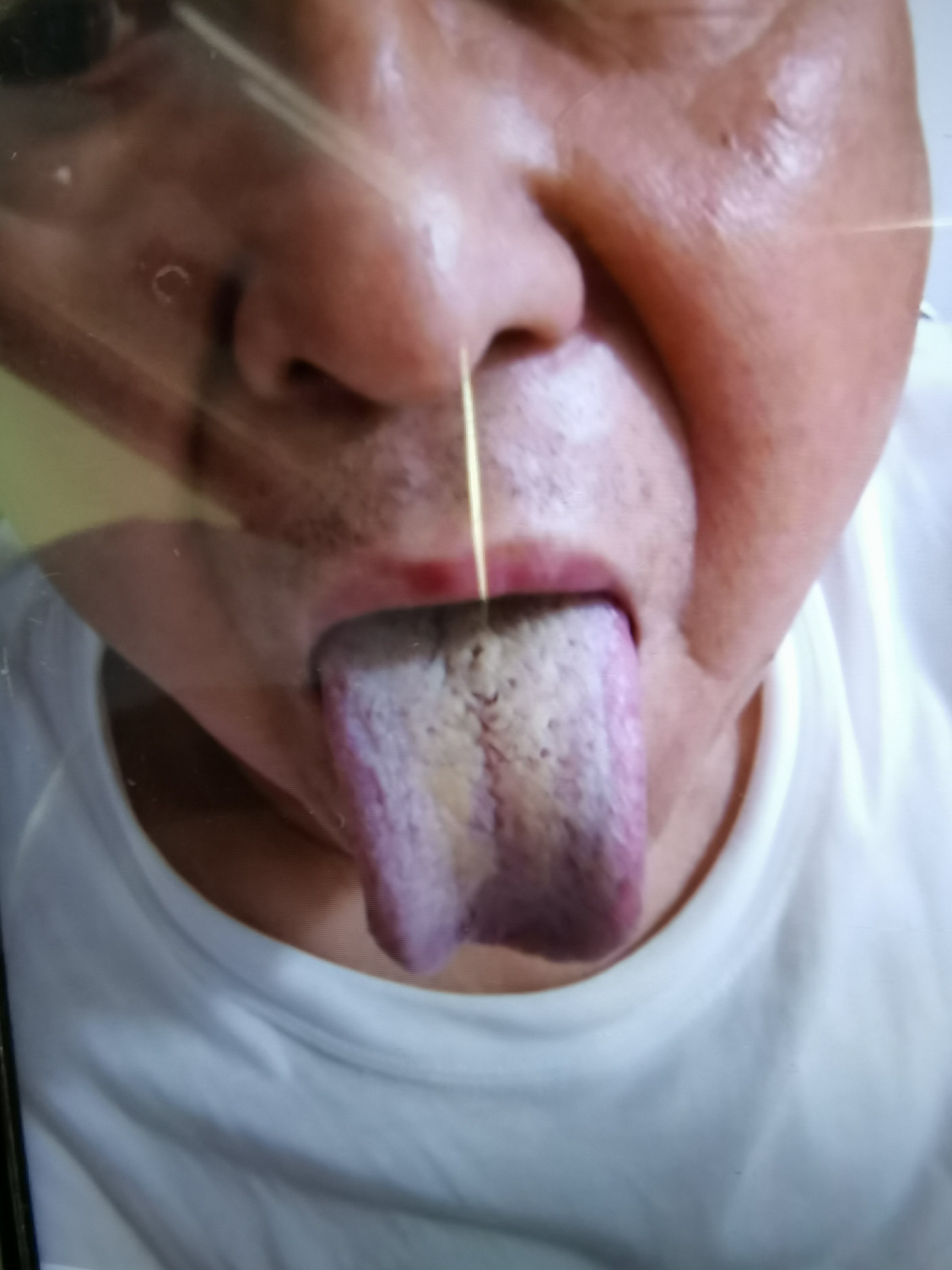 男，74岁，胆囊切除术后40年，疑似胆管癌 舌面.jpg