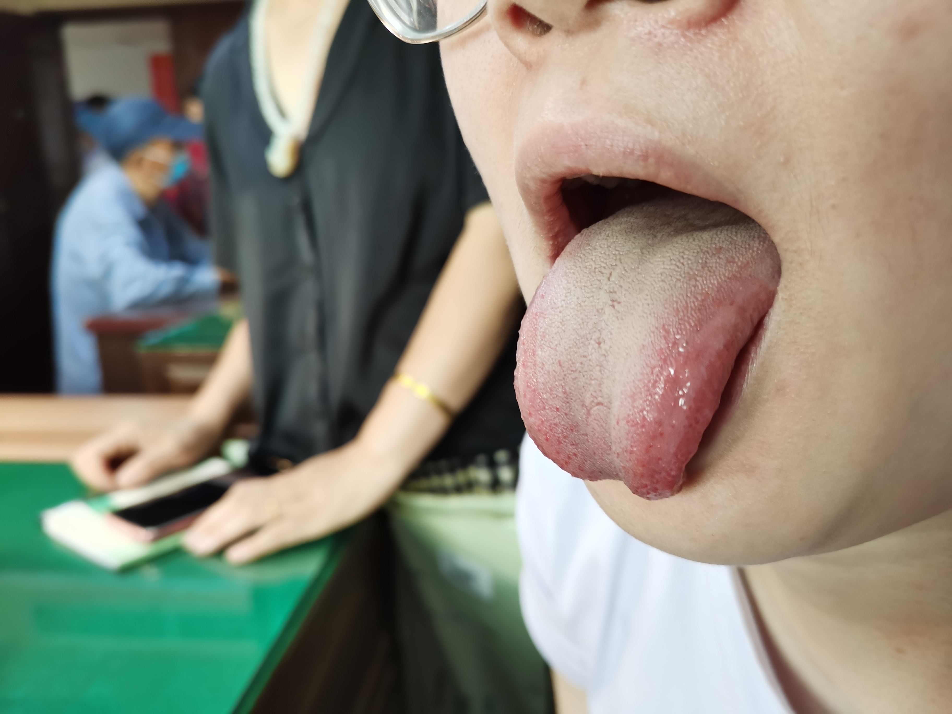 女，26岁，左手食指无力，双足屈不能2年余 舌面.jpg