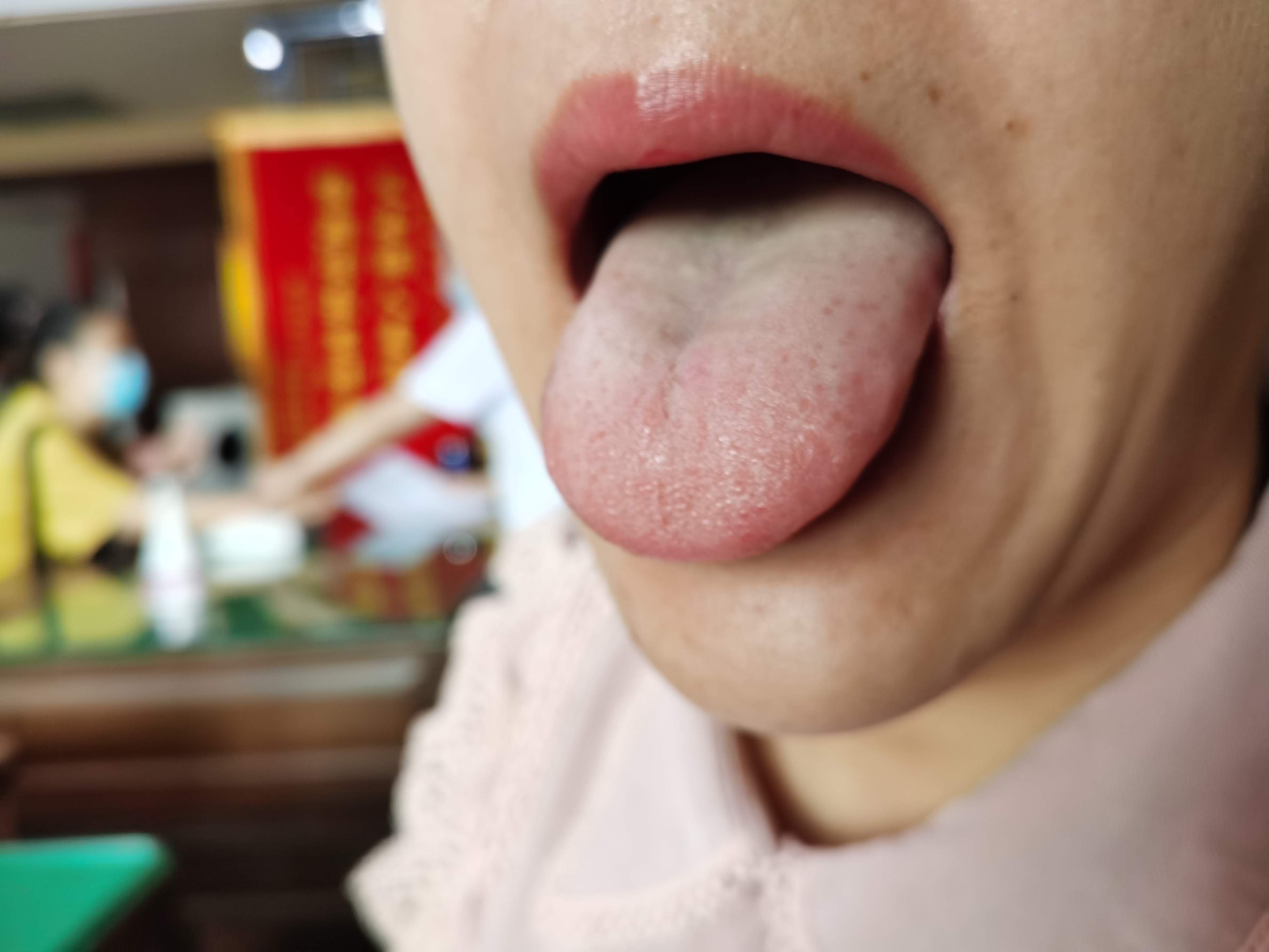 女，33岁，肌肉萎缩4年 舌面.jpg