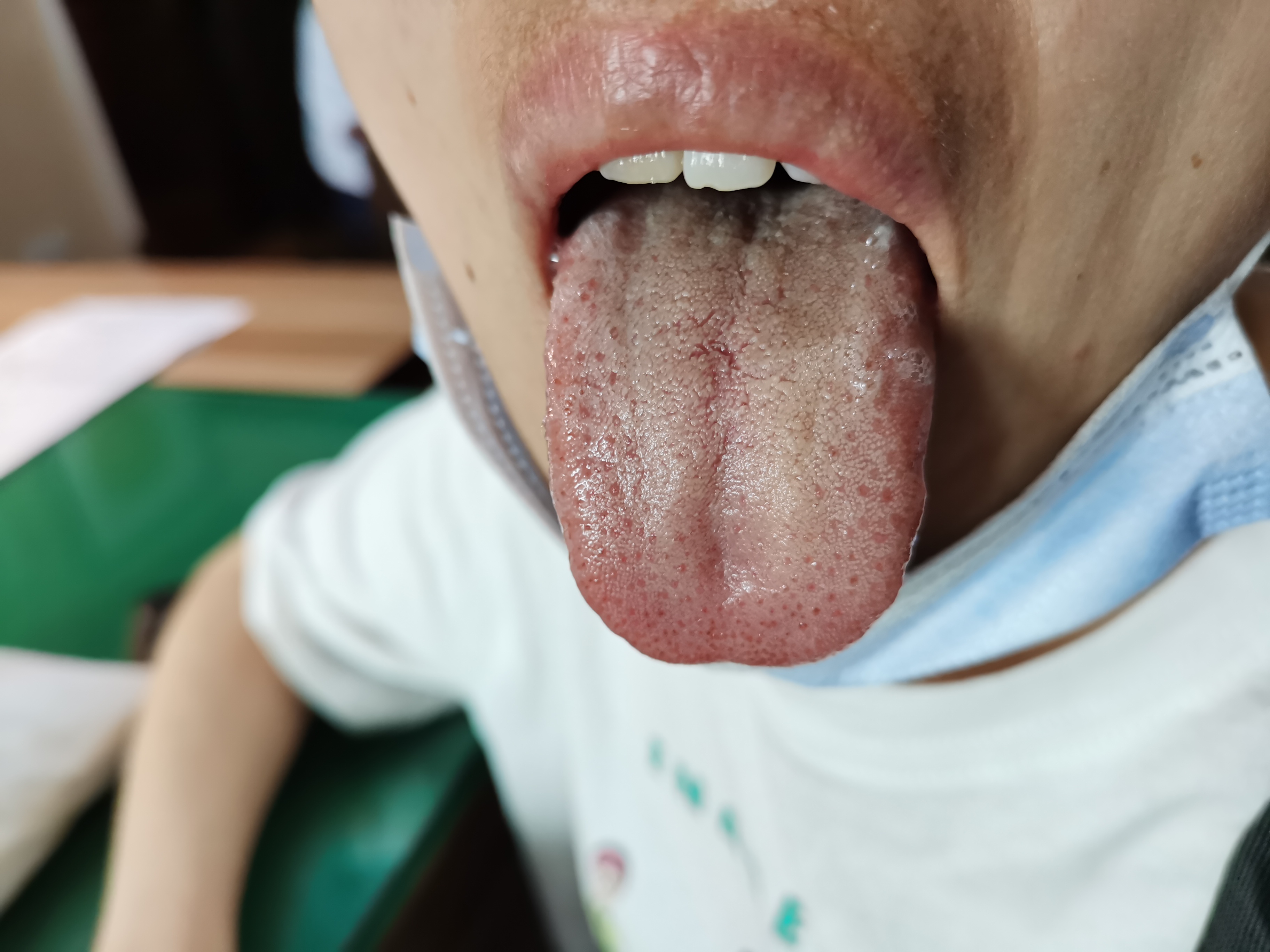 女，34岁，甲减伴喉颈部疼痛6月 舌面.jpg