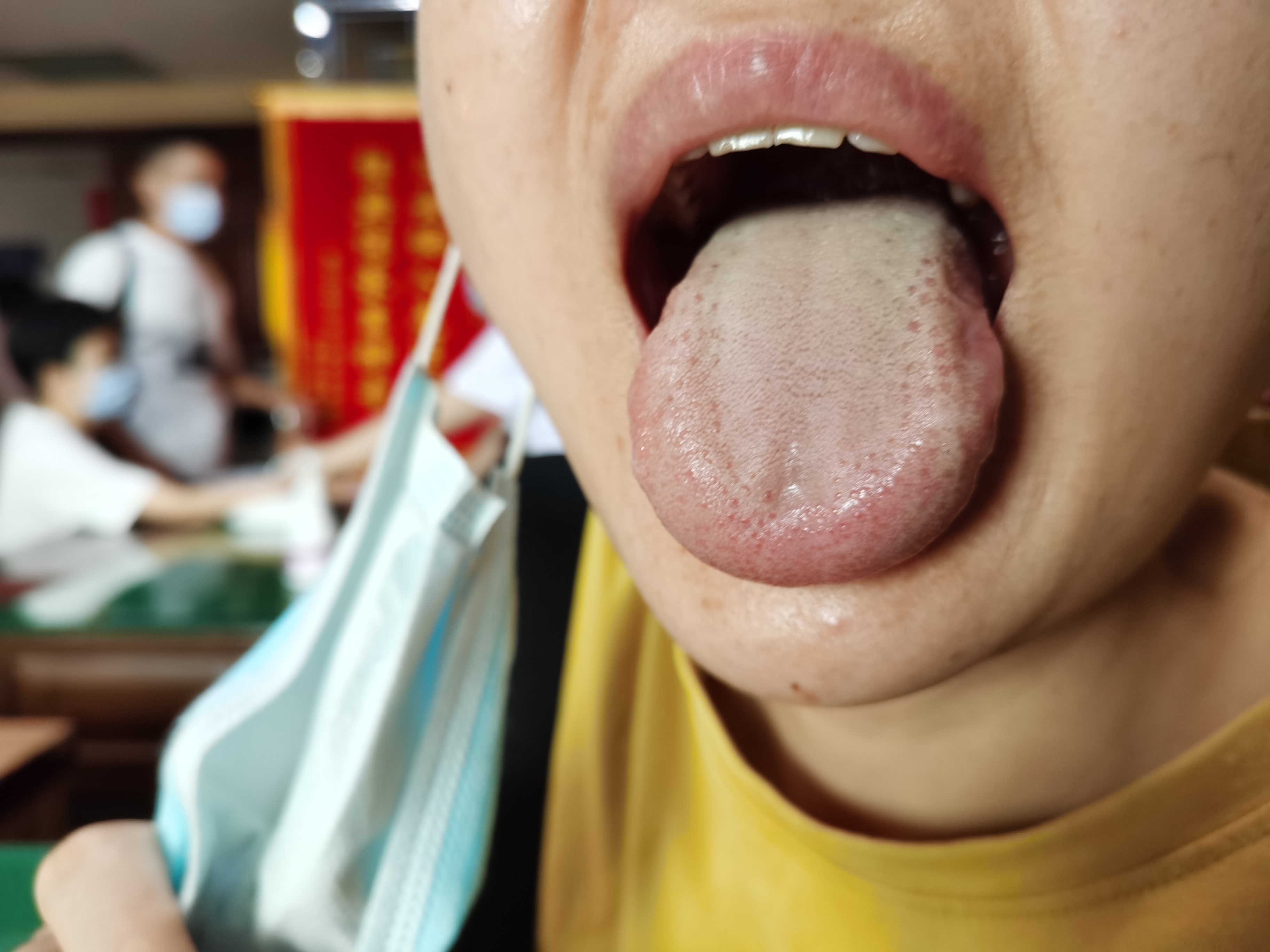 女，36岁，大便干结与腹泻交替进行1年余 舌面.jpg