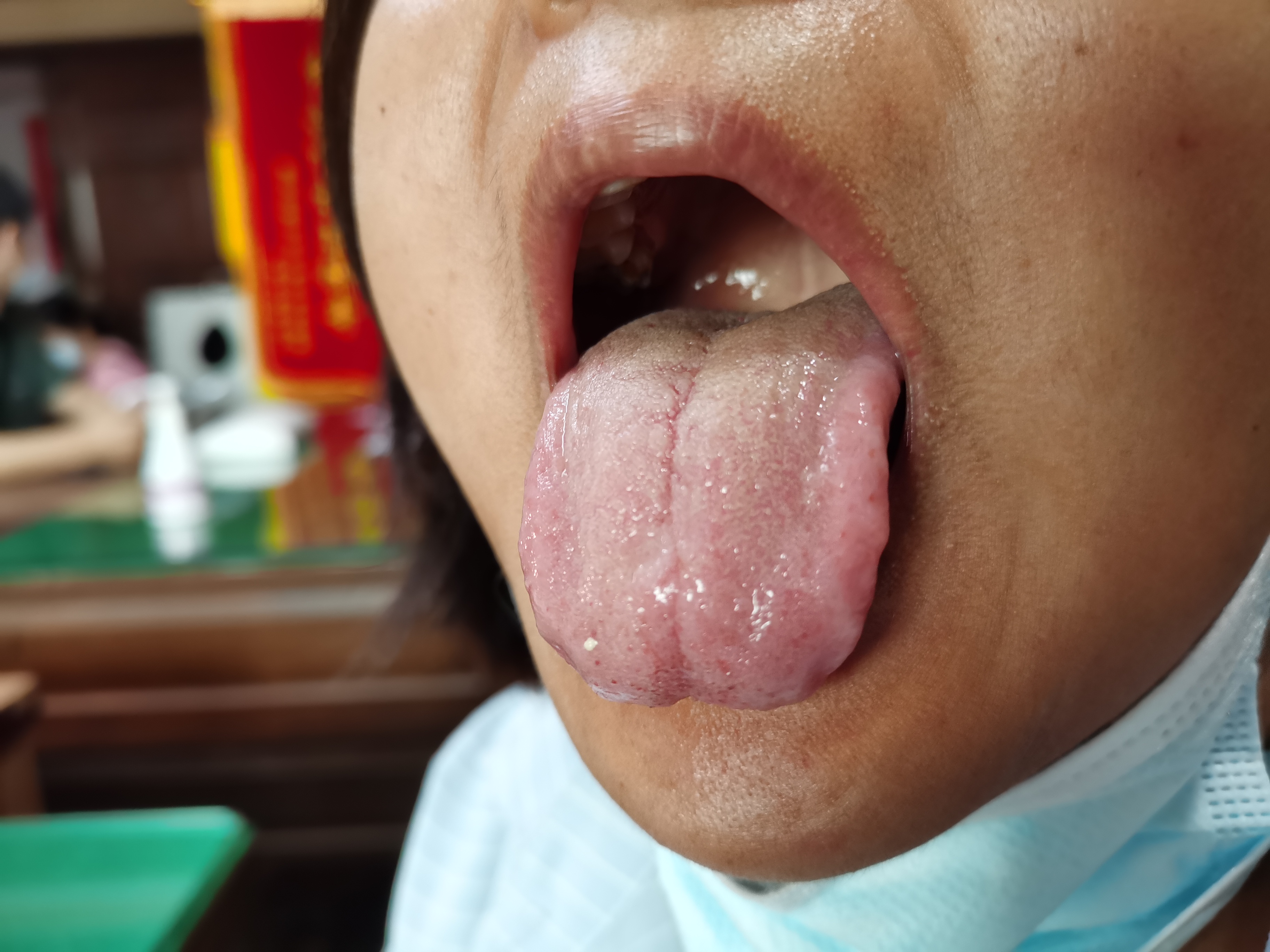 女，39岁，肌无力13年余 舌面.jpg