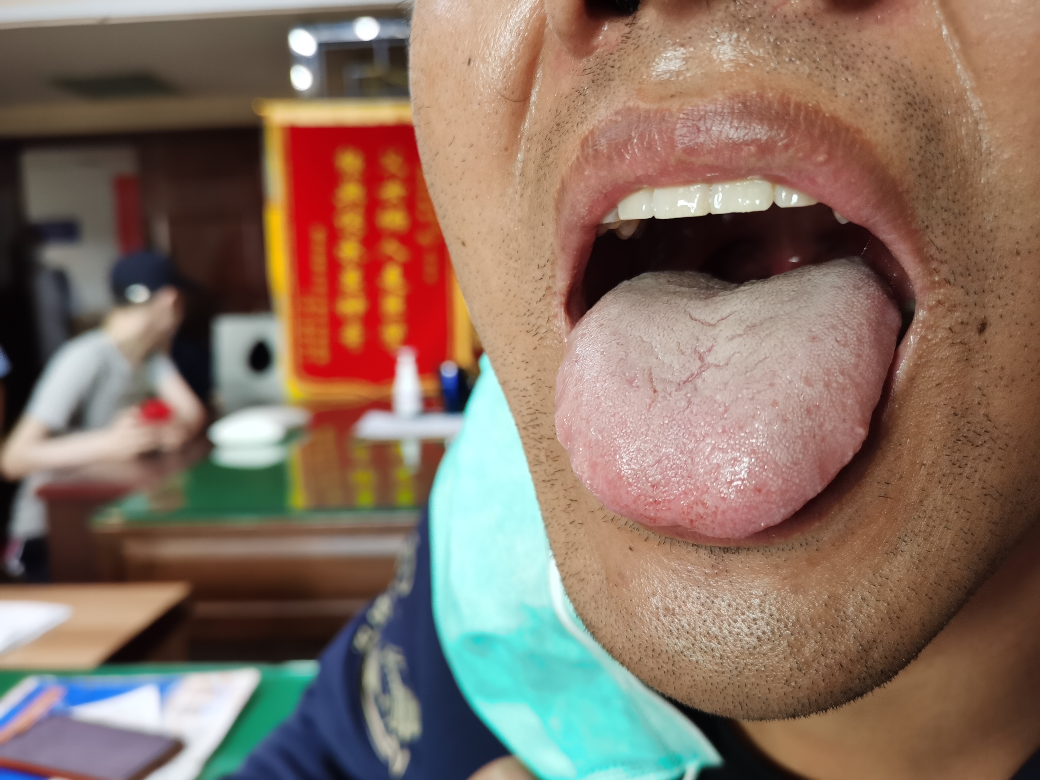 男，27岁，双下肢乏力伴萎缩3年余 舌面.jpg