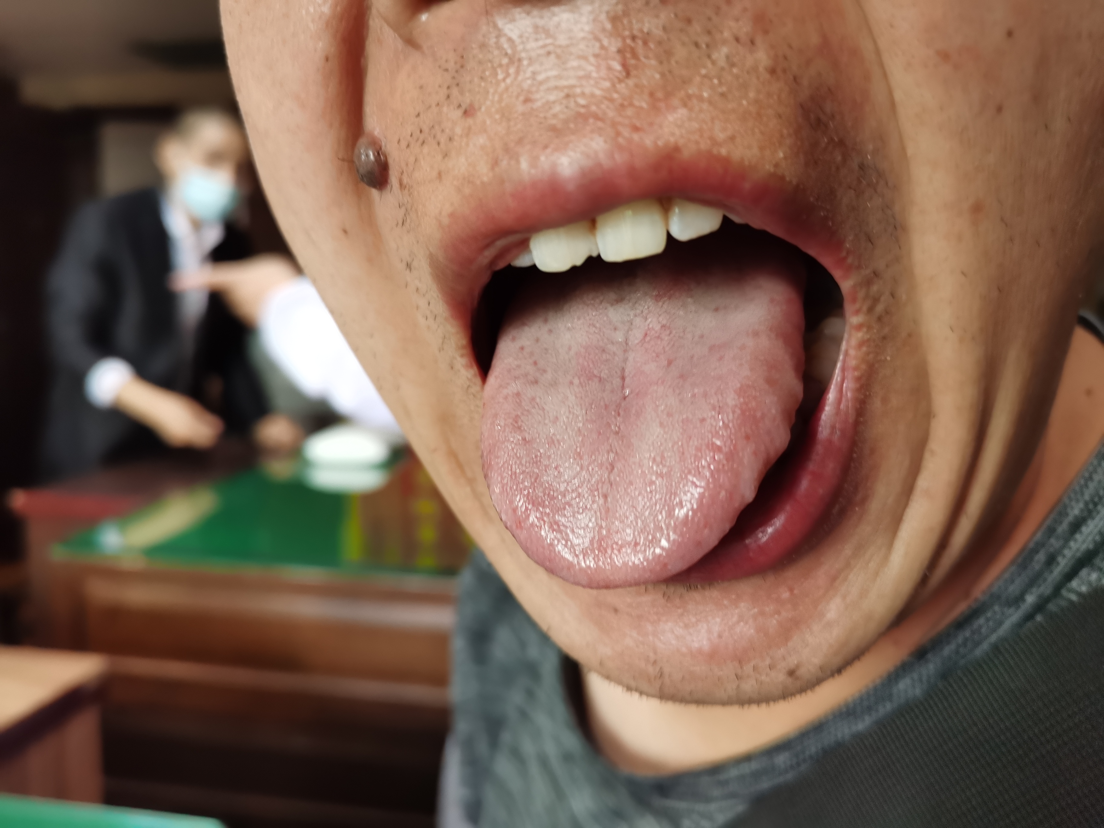 男，40岁，发现感染乙肝病毒13年余 舌面.jpg