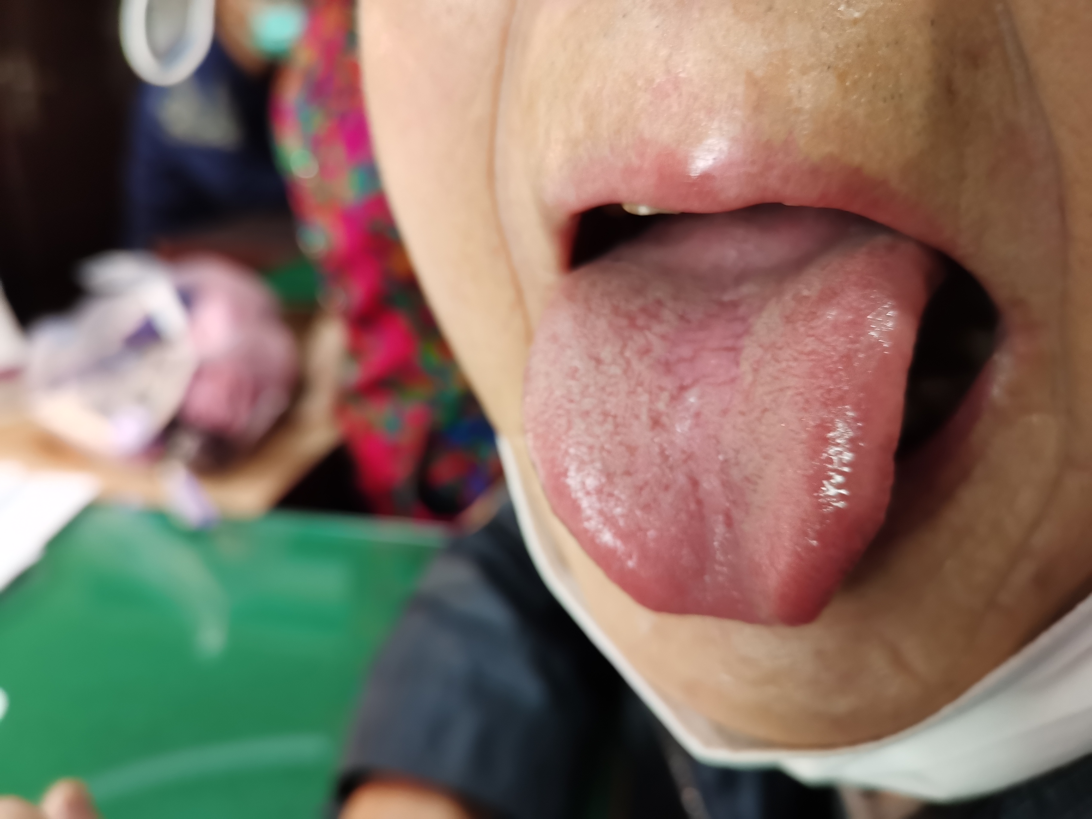 男，76岁，肺癌术后2年余 舌面.jpg