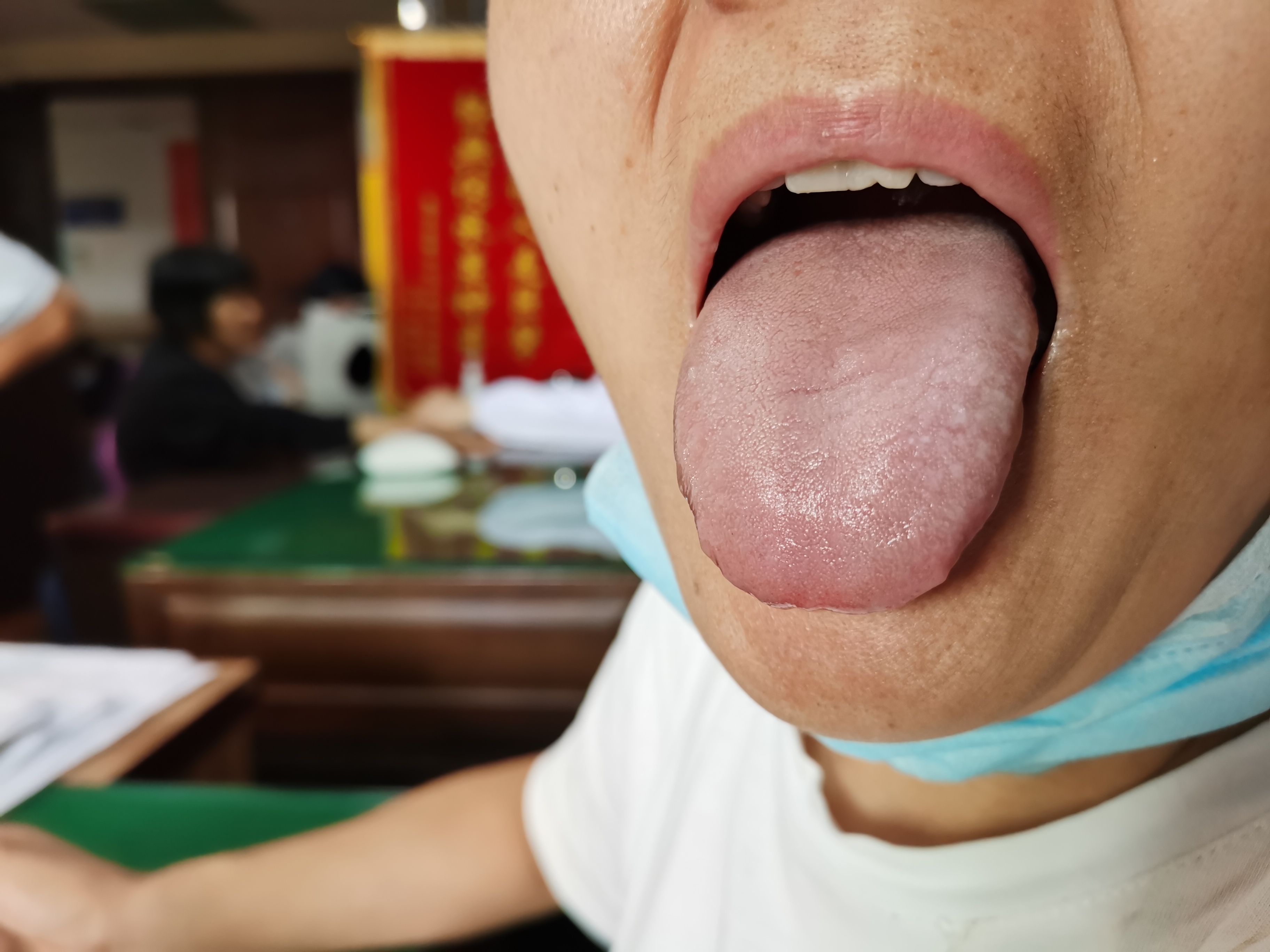 女，47岁，上半身游走性胀痛数年 舌面.jpg