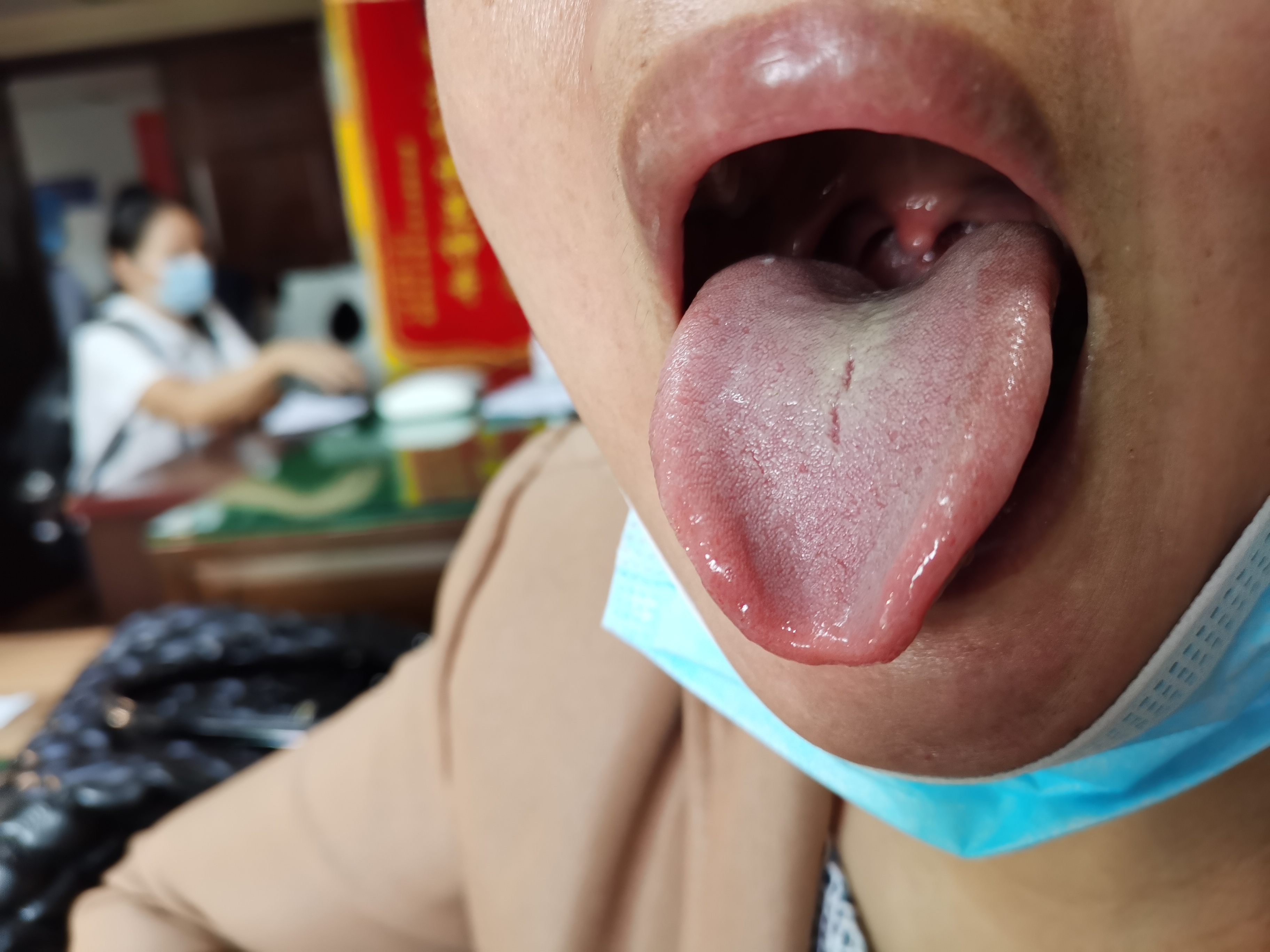 女，51岁，畏寒两年余 舌面.jpg