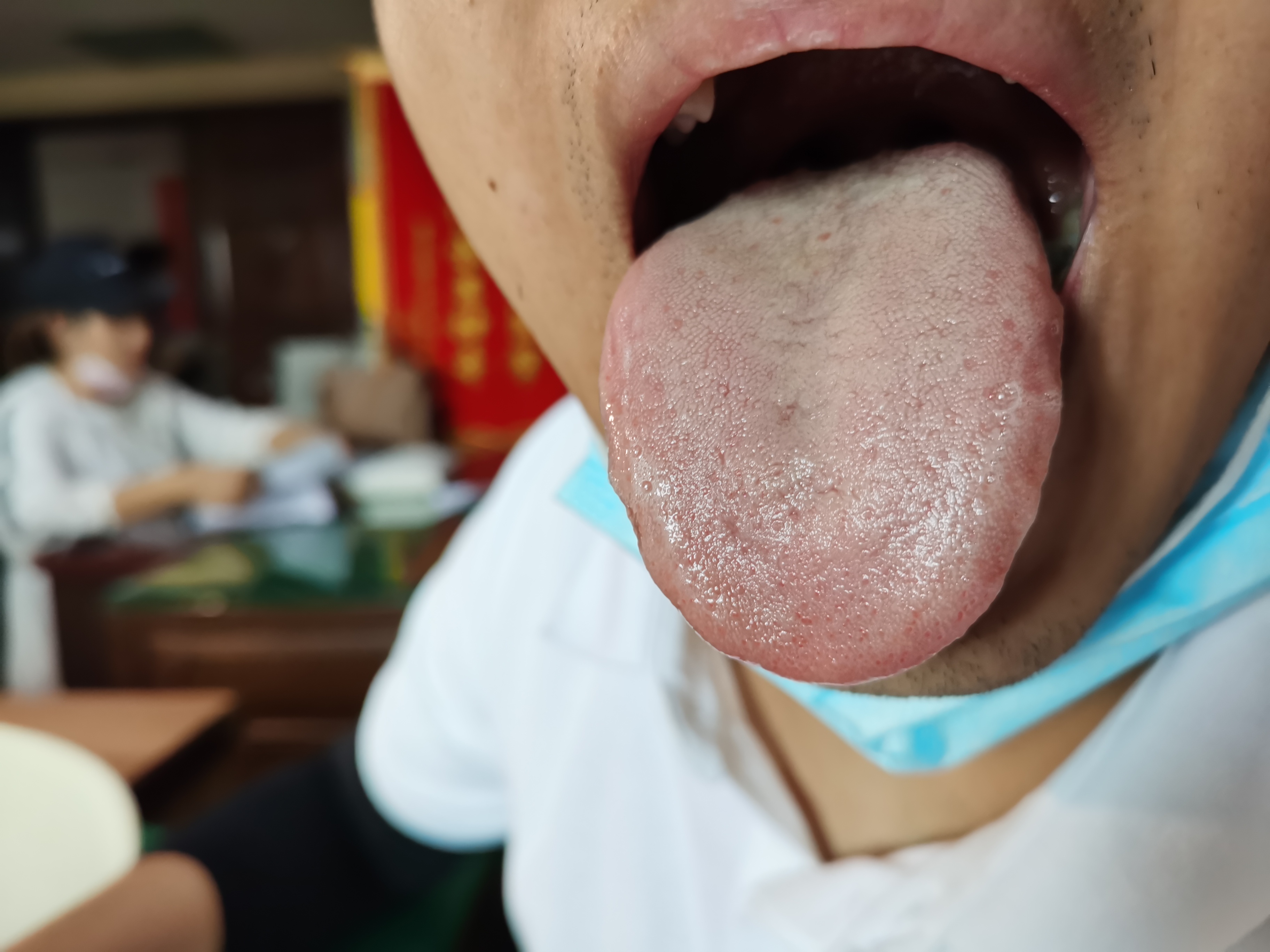 男，22岁，脱发2年 舌面.jpg