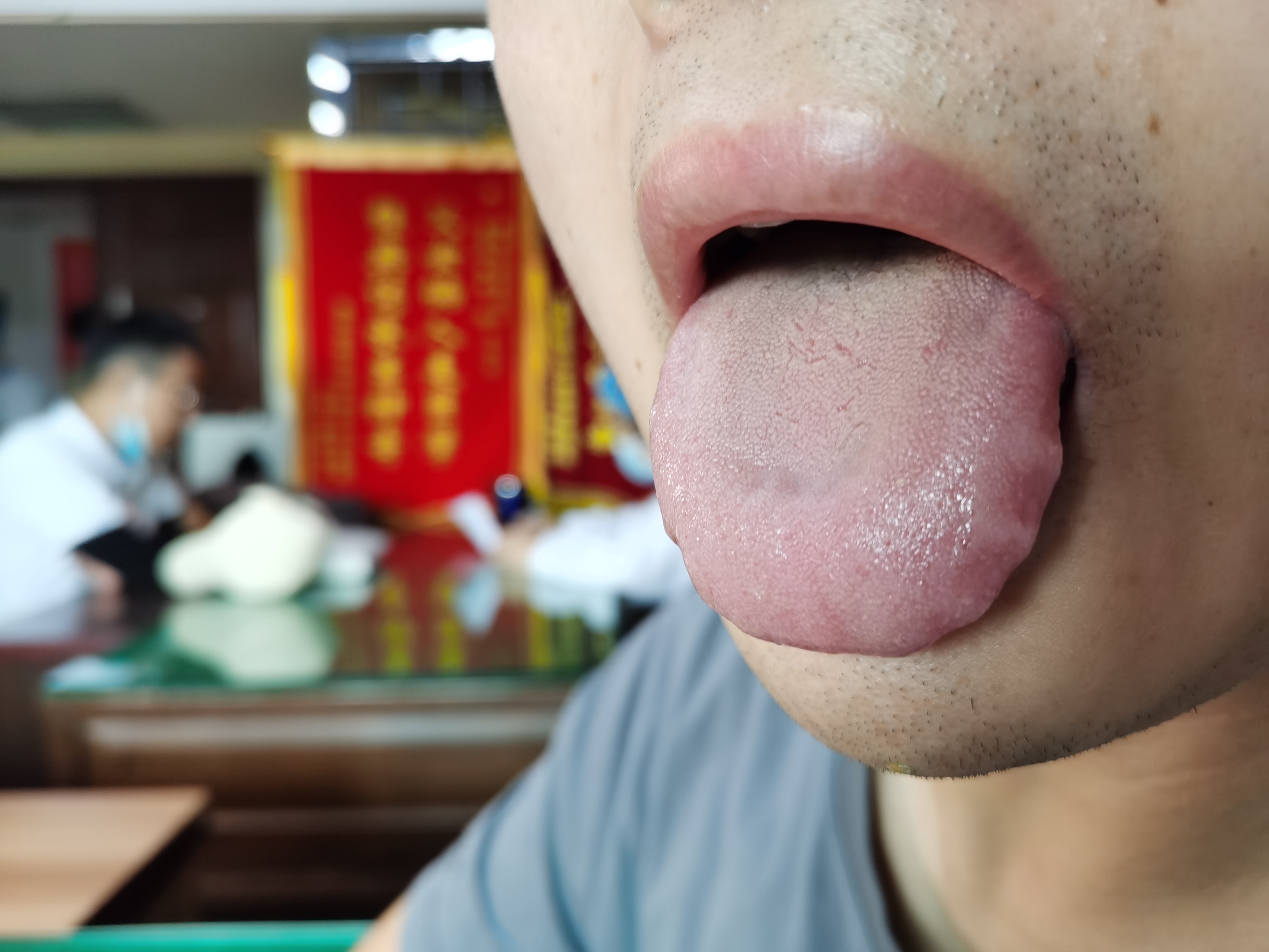 男，33岁，腰酸乏力1年余 舌面.jpg