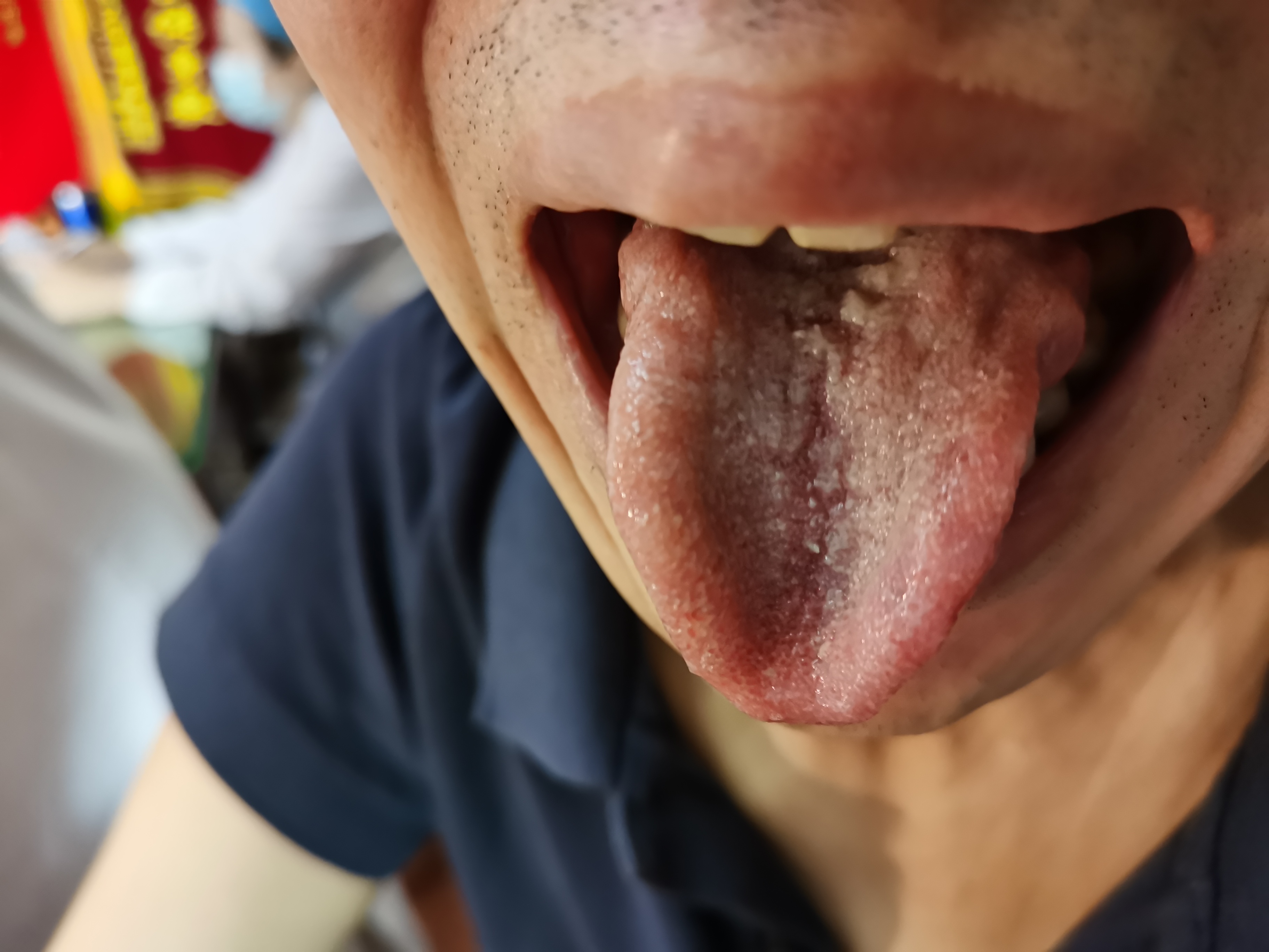 男，57岁，进行性言语不利伴四肢无力3年 舌面.jpg