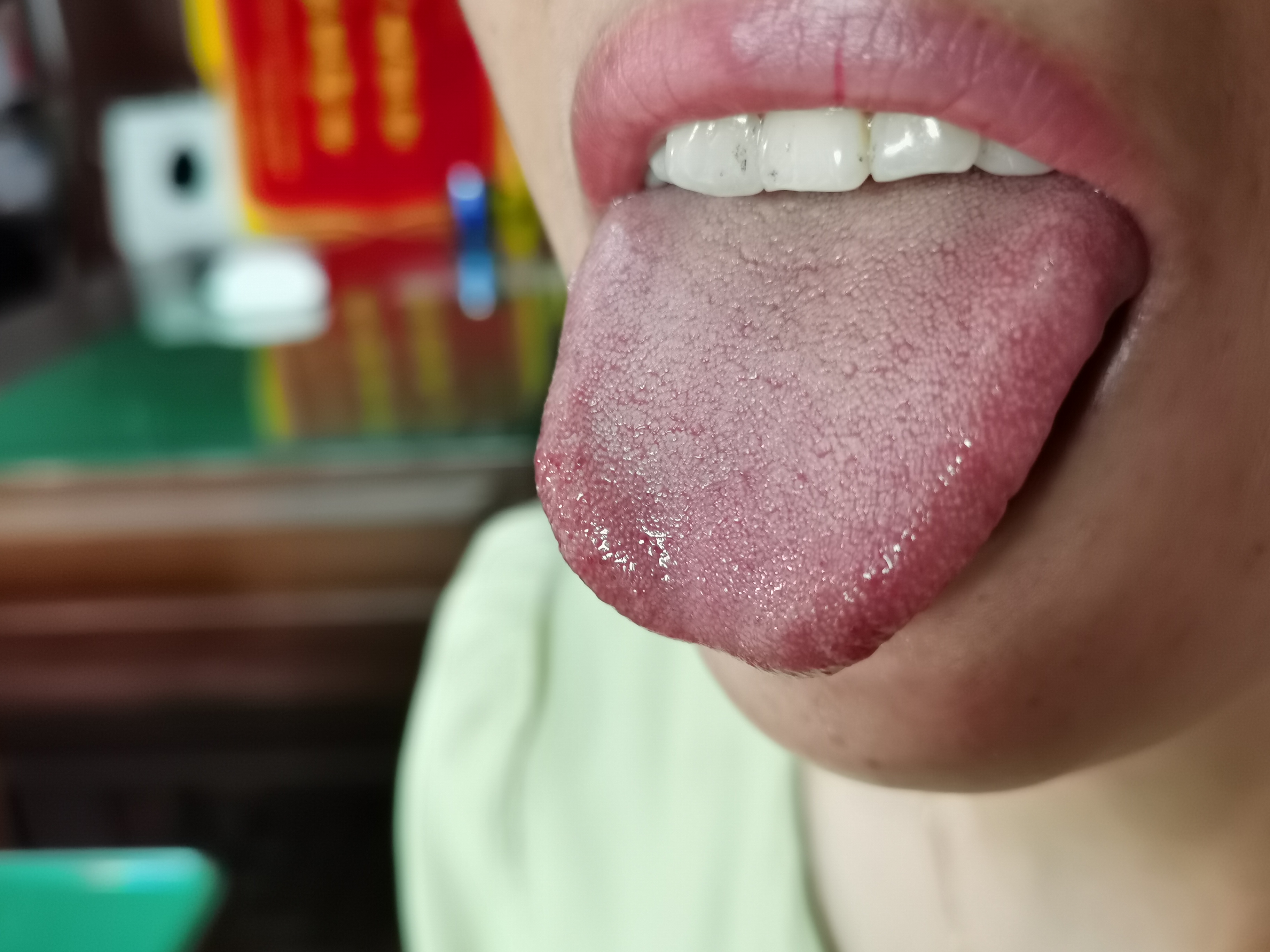 女，39岁，四肢肌肉渐进性萎缩4年余 舌面.jpg