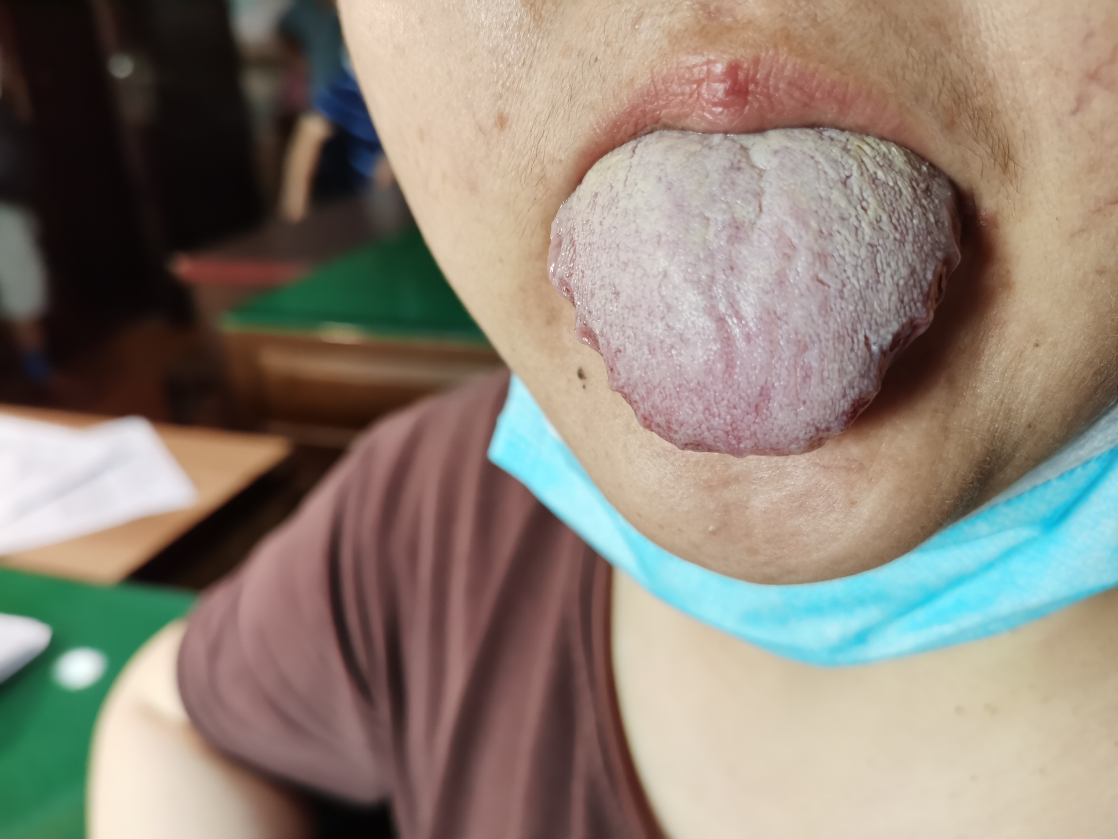 女，41岁，胰腺癌放化疗5月余 舌面.jpg