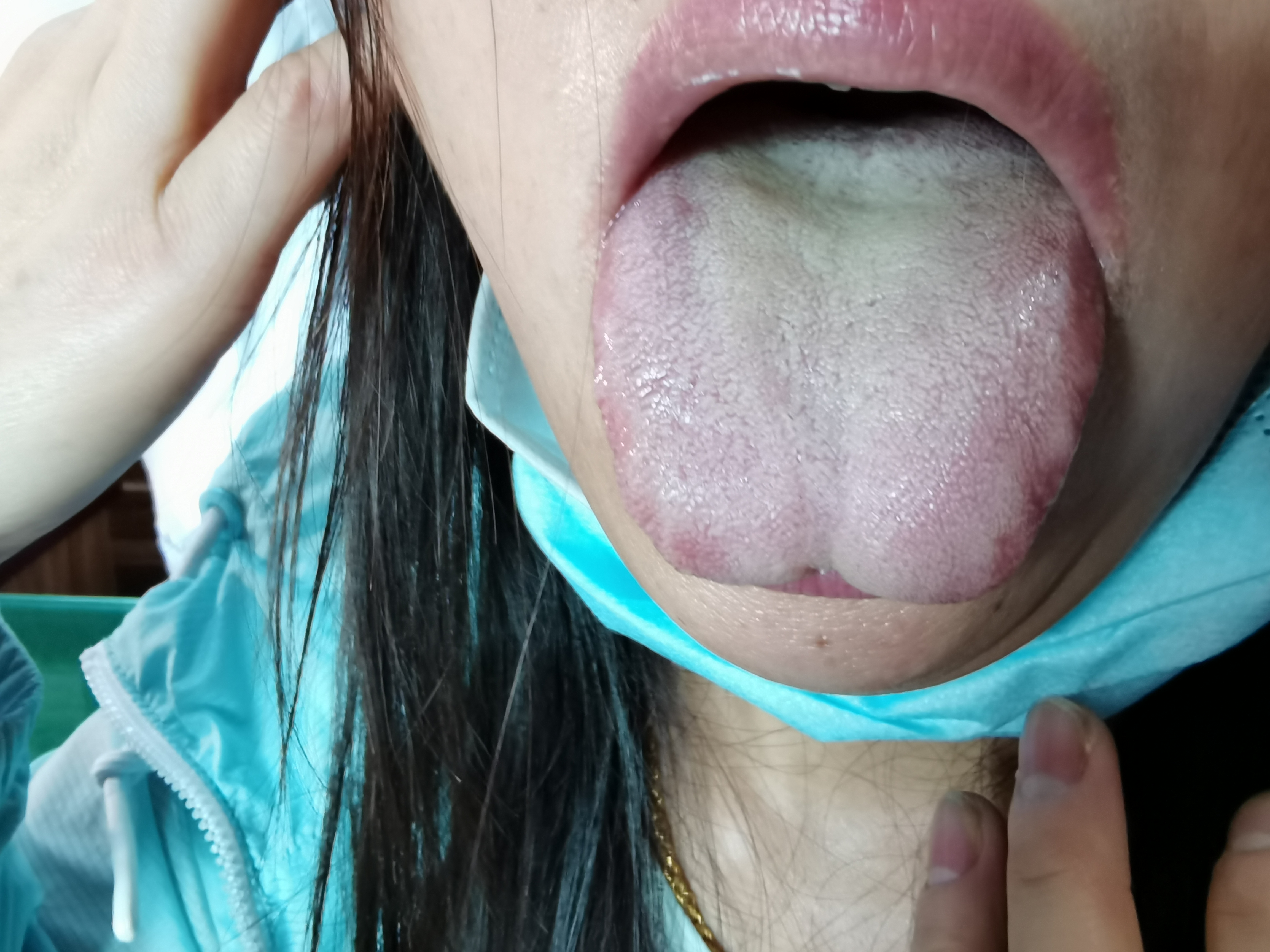 女，46岁，左侧下腹部疼痛6年余 舌面.jpg