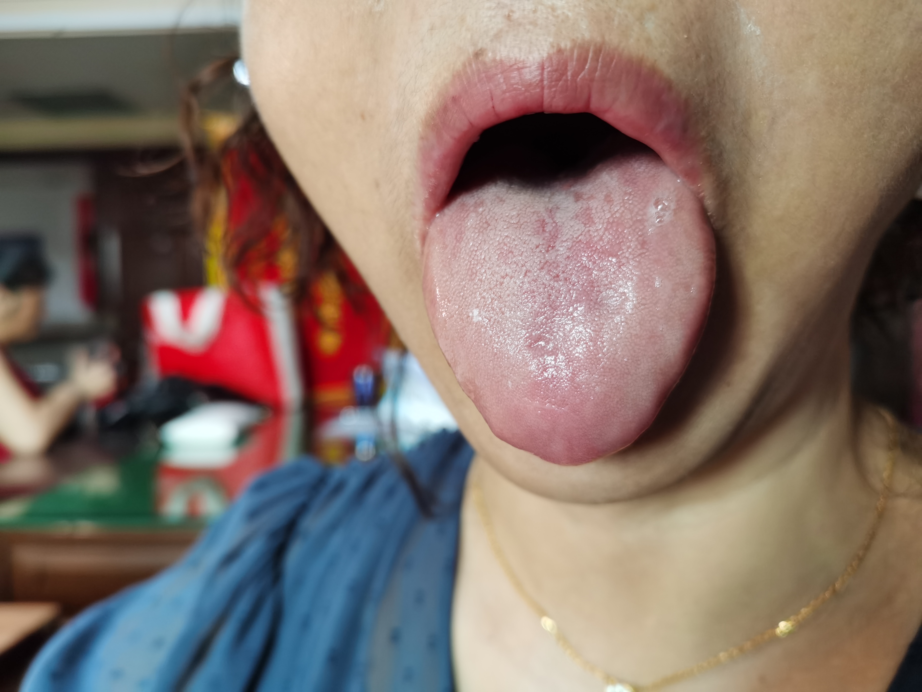 女，55岁，失眠两年余 舌面.jpg